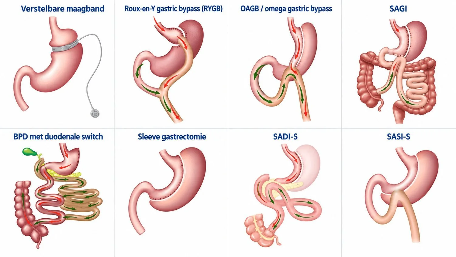 Overzicht van de bariatrische technieken: gastric bypass, gastric sleeve, mini gastric bypass (OAGB) en SADI-S