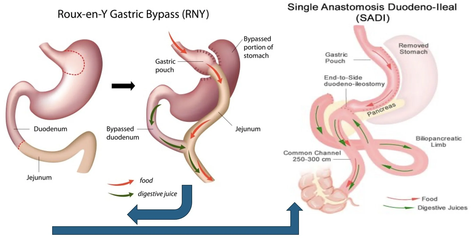 Conversie van een gastric bypass naar een SADI
