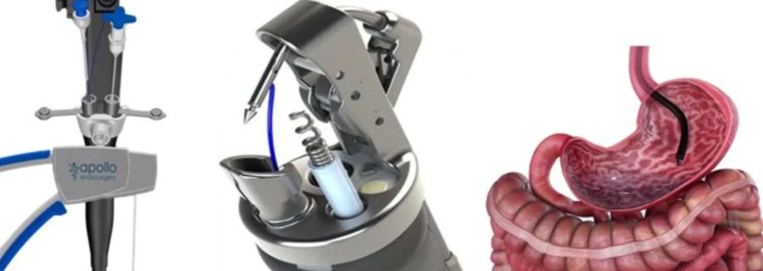 Endoscopische sleeve gastroplastie (ESG): het hechtsysteem en de maag na plooiing