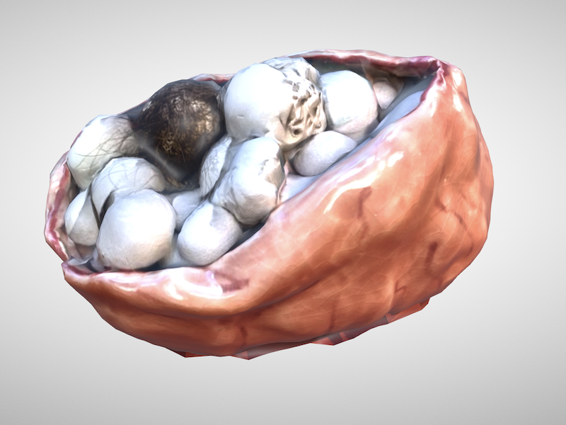 Preview_Teratoma_Friedl.png