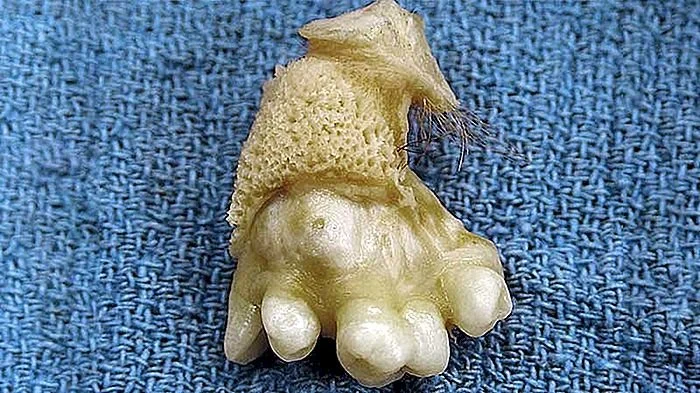 teratoma-de-ov-rio-tipos.jpg