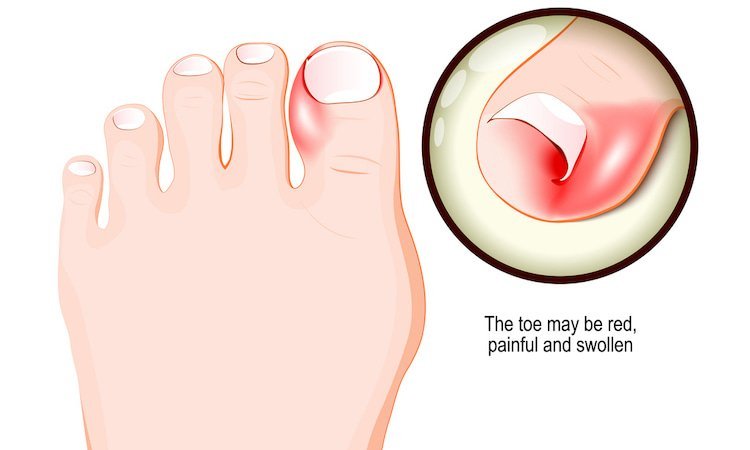 ingrown toenail treatment melbourne