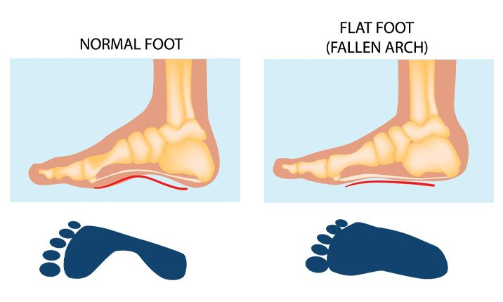 children flat feet causes