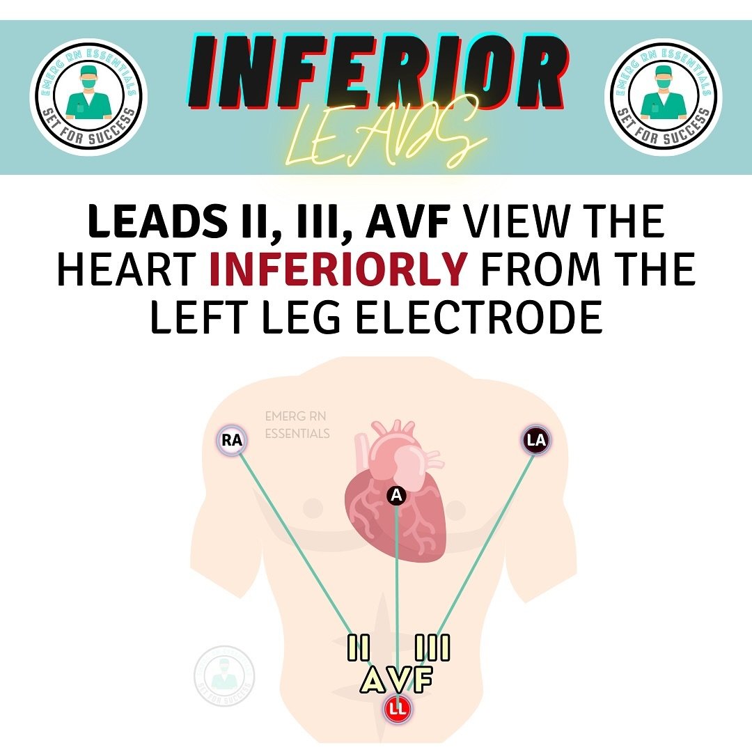 INFERIOR LEADS: LEADS II, III, aVF. 
.
Want to elevate your ECG skills? 
Get ECG ESSENTIALS: 12 LEAD ECGs!
Link in bio 🔗 
.
#ecg #ekg #bscn #bscnursing #nursing #nursingstudent #nclex #nurselife #nursesofinstagram #emergrnessentials