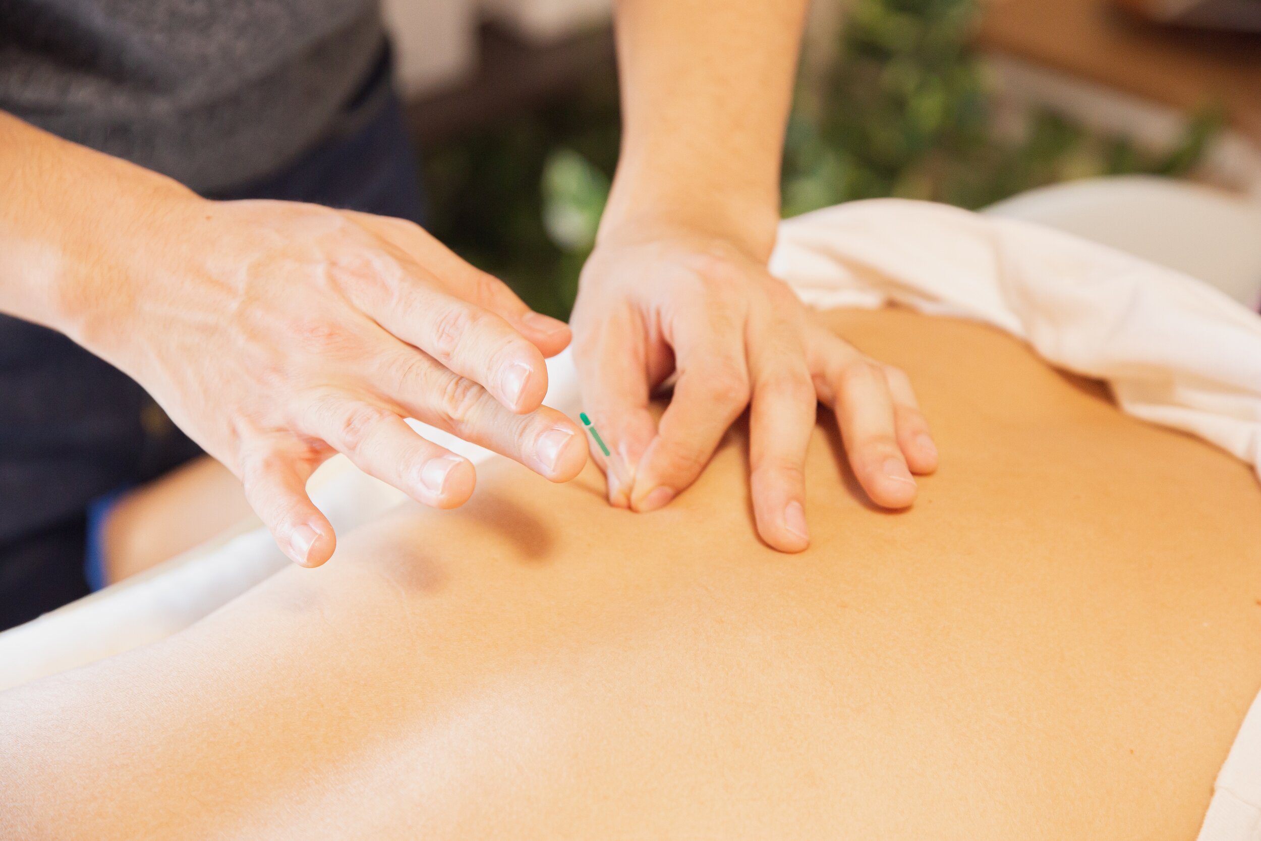 Acupunture vs. Dry Needling