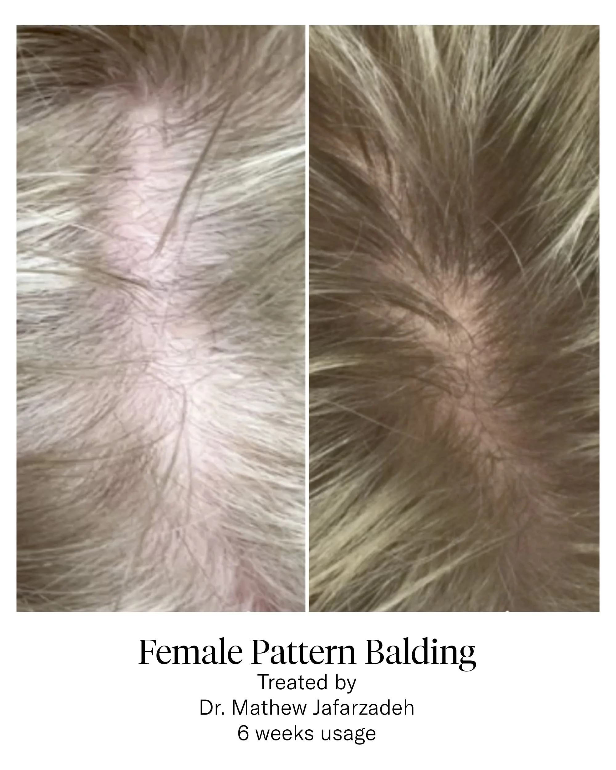 CALECIM® Hair Serum Before and After