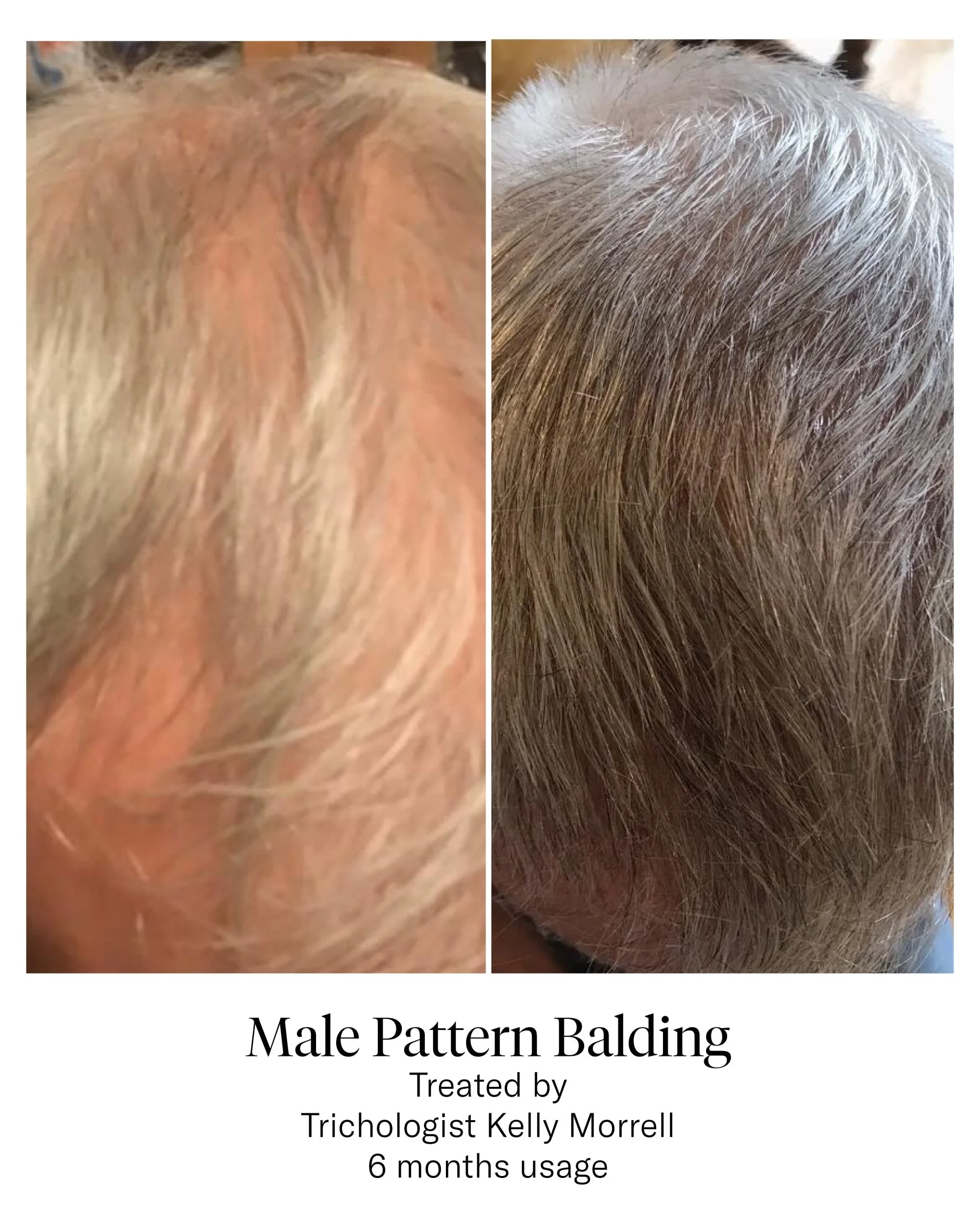 CALECIM® Hair Serum Before and After