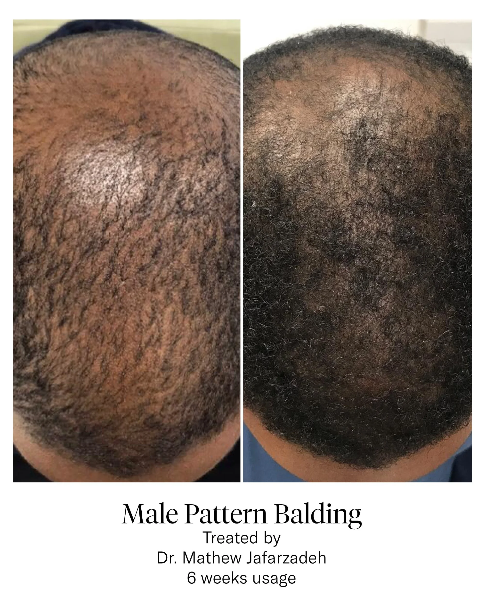 CALECIM® Hair Serum Before and After