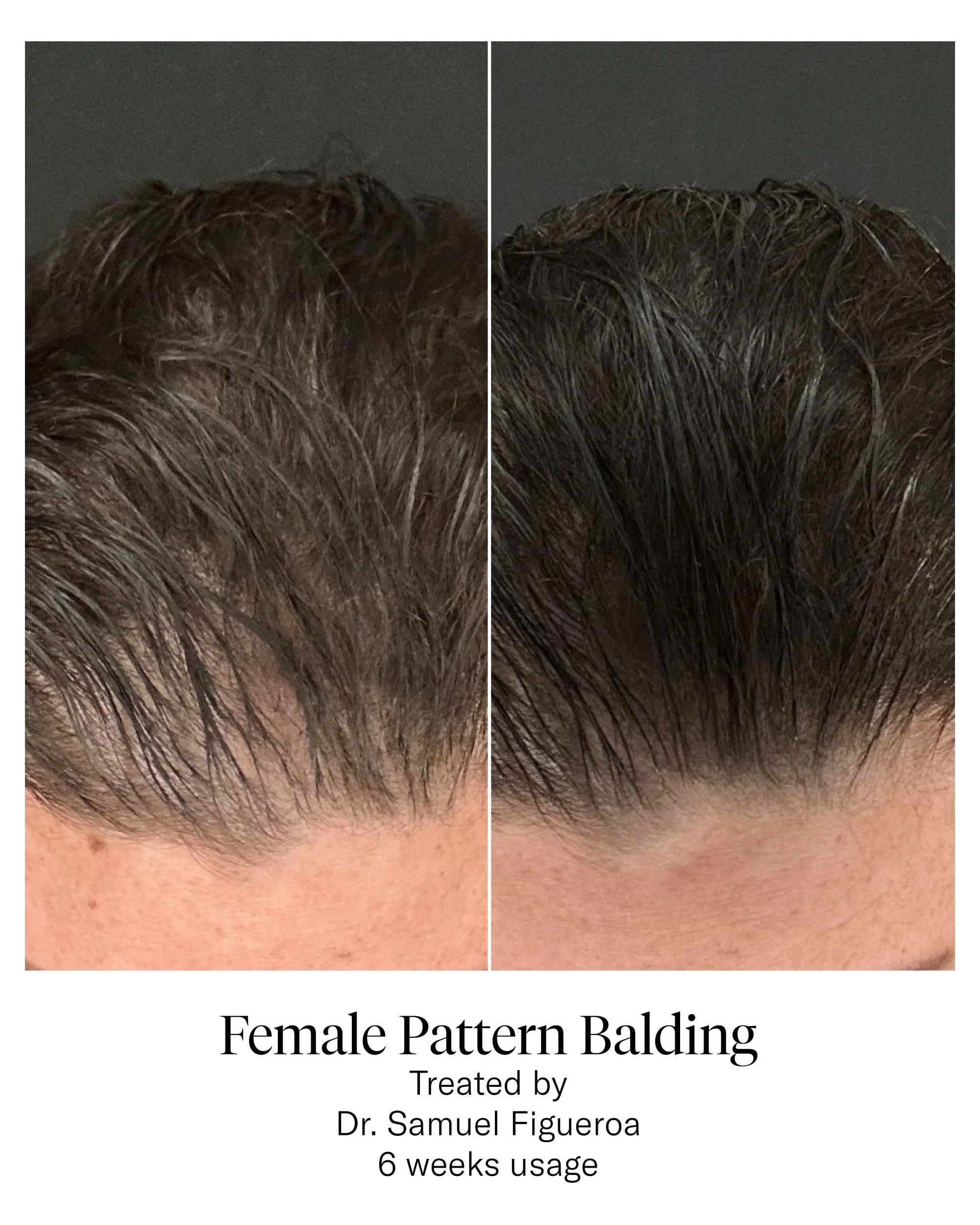 CALECIM® Hair Serum Before and After