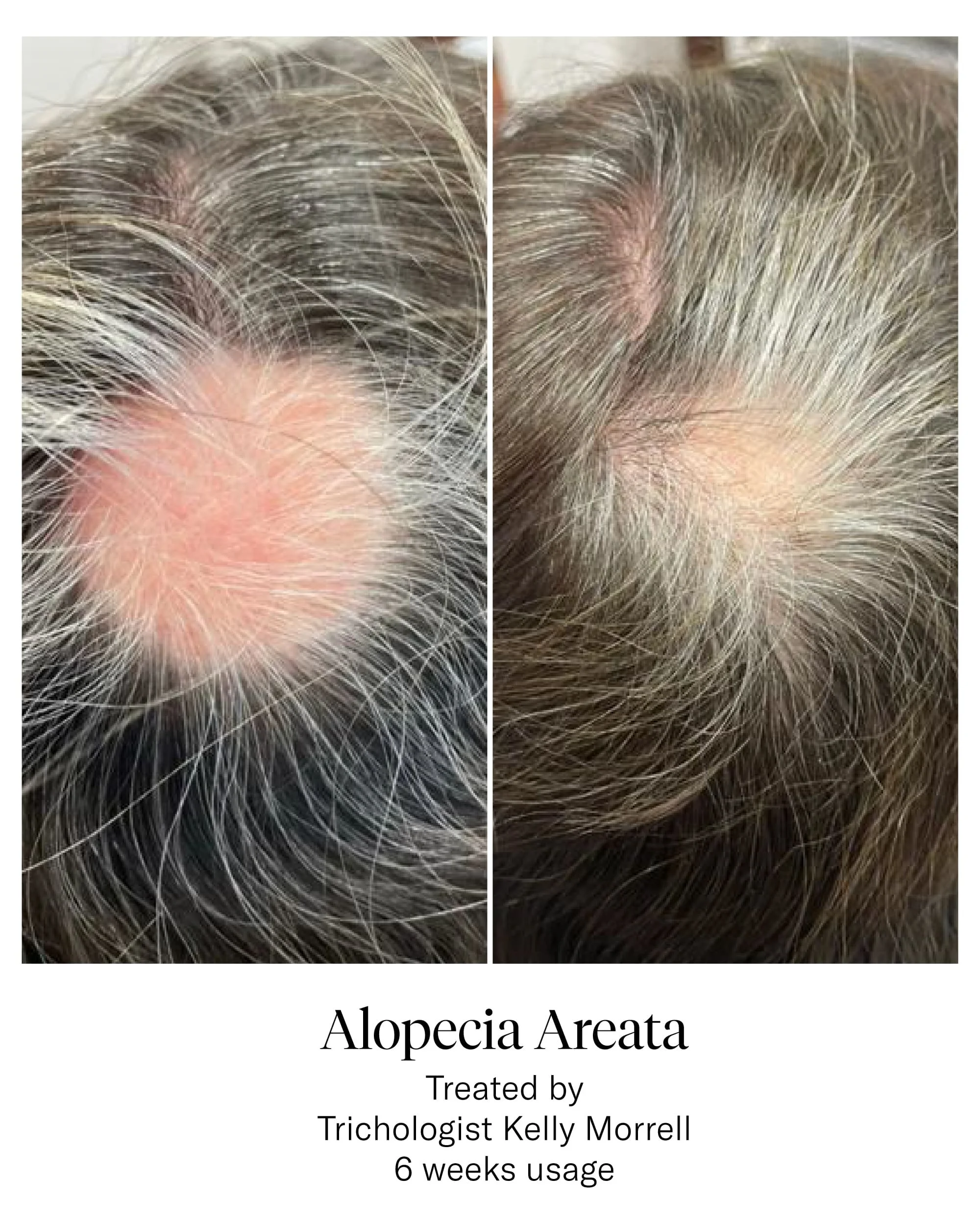 CALECIM® Hair Serum Before and After