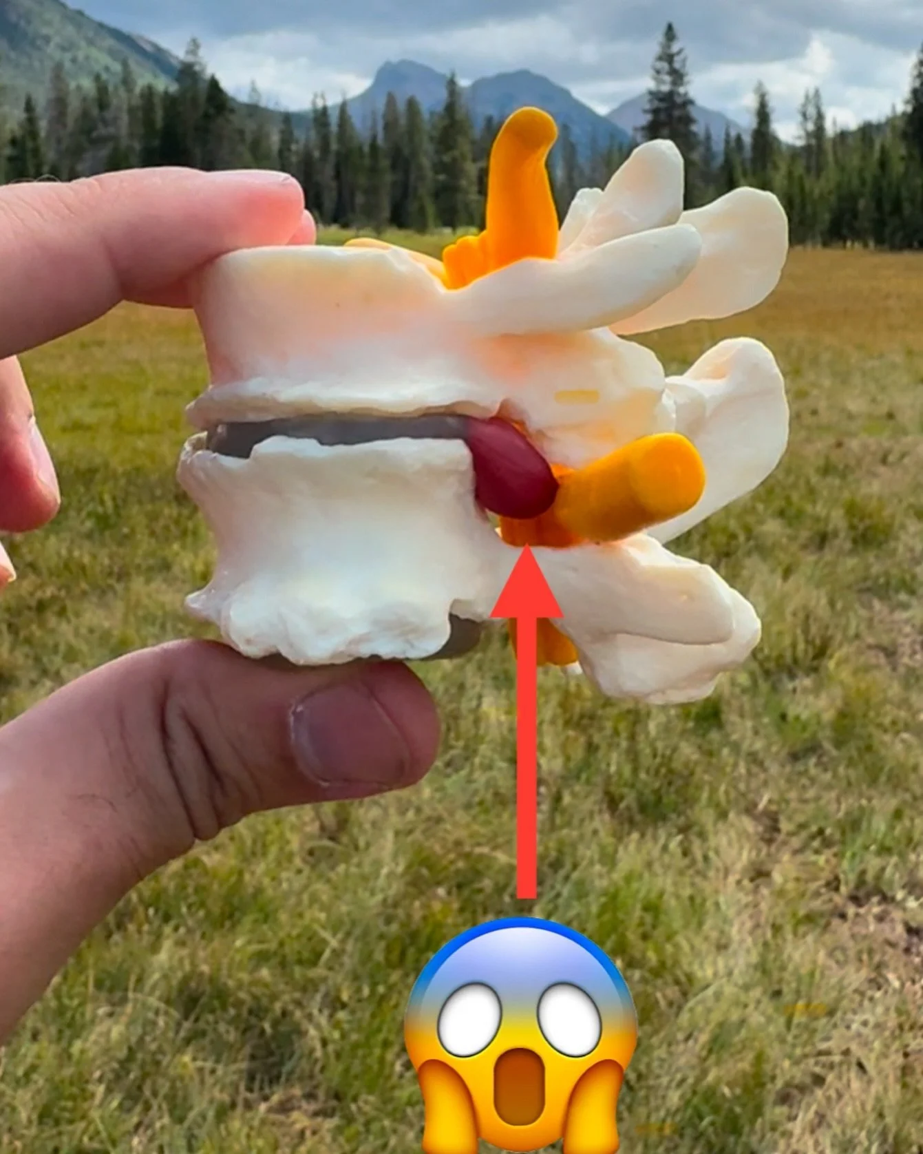 A lumbar disc herniation, often called a &ldquo;slipped disc&rdquo; or &ldquo;ruptured disc,&rdquo; happens when one of the soft, jelly-like cushions (in red) between the bones in your lower back pushes out of its normal position. This can irritate n