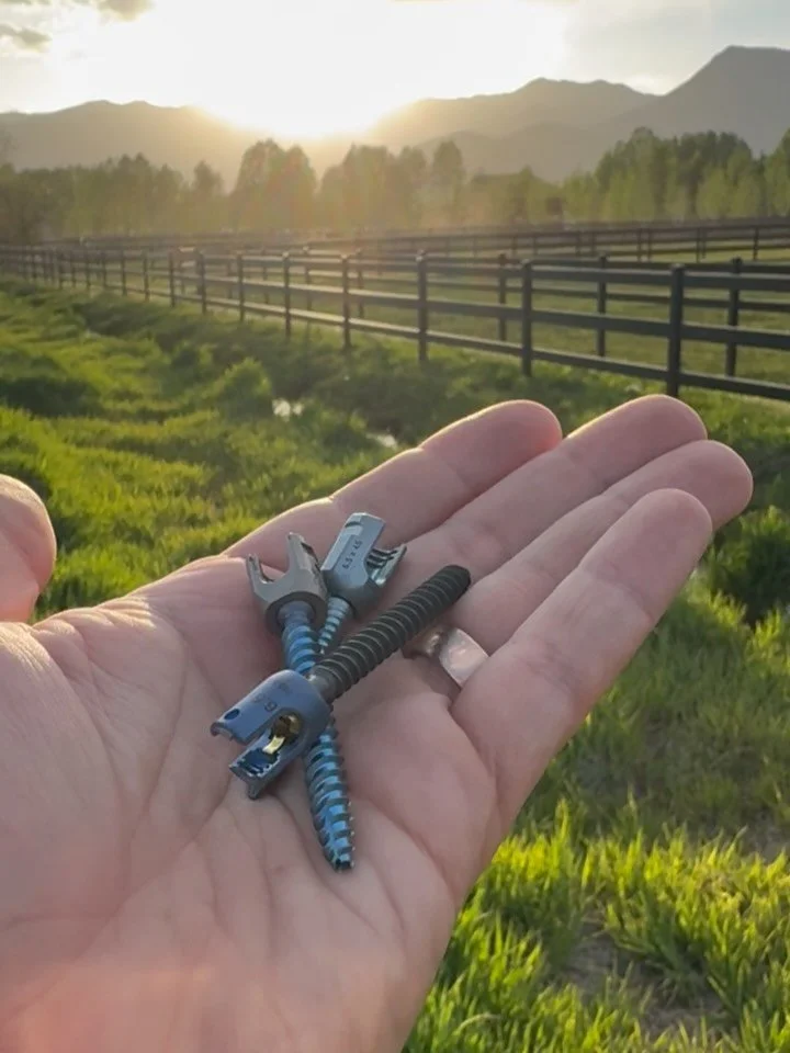 Pedicle screws are small titanium screws placed in the vertebrae to provide stability to the spine.

They are commonly used as part of a spinal fusion or to stabilize an unstable spinal fracture.

The screws are connected to rods, creating a rigid fr