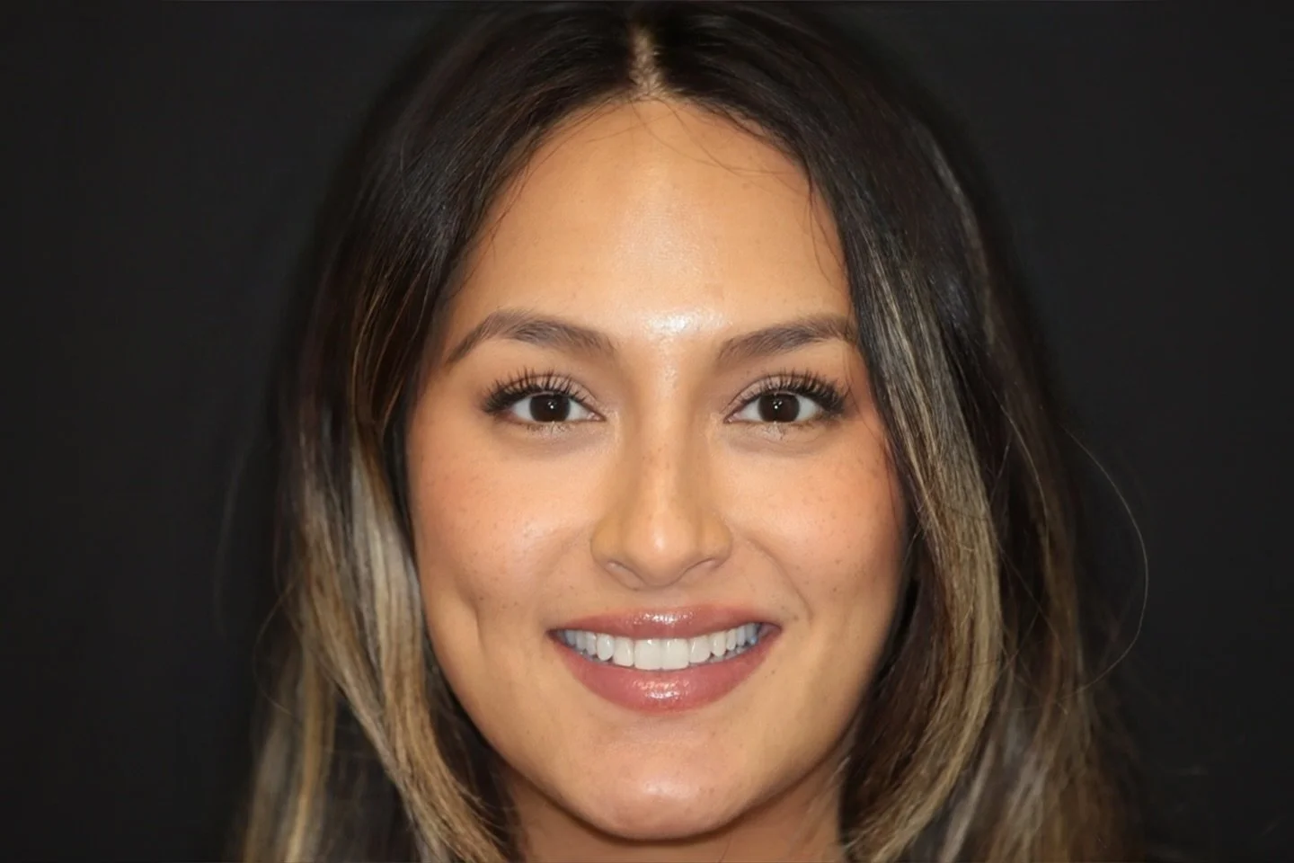 Sculpted Miel Composite: replacement 🍸🦷 #bostondentist #peabodydentist #compositebonding #porcelainveneers #fyp #bostonma