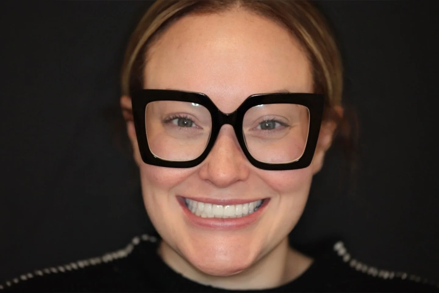 Miel Sculpted Porcelain Veneers💕 #bostondentist #porcelainveneers #compositeveneers #fyp