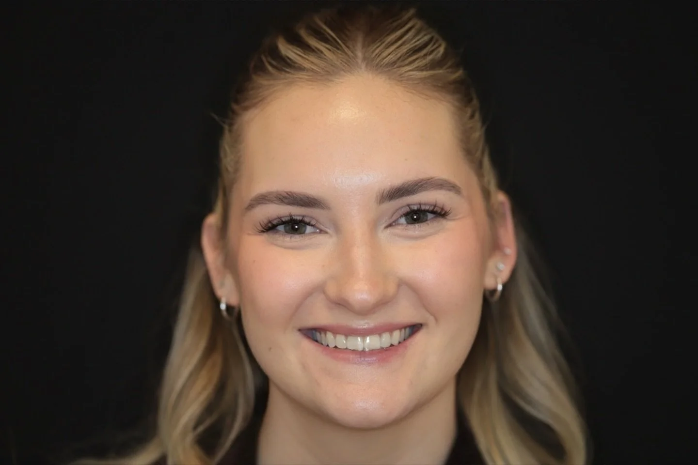 TMJ and tension headaches treatment: we injected the masseter , temporalis, frontaljs and glabellar region. 2 weeks post op 💕 #tmd #tmj #botox