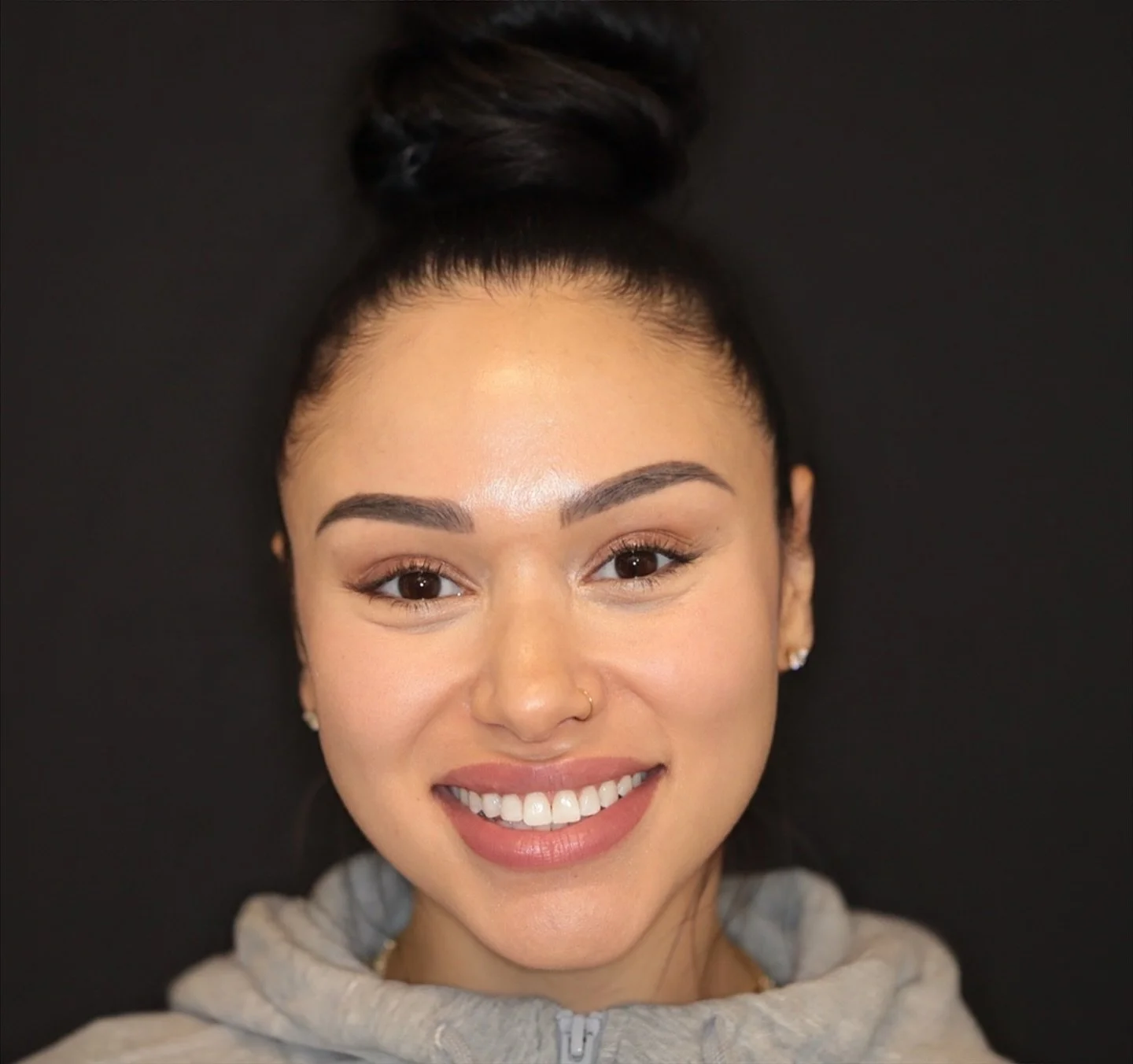 Our Sculpted Composite #bostondentist #peabodydentist #compositebonding #fyp #porcelainveneers