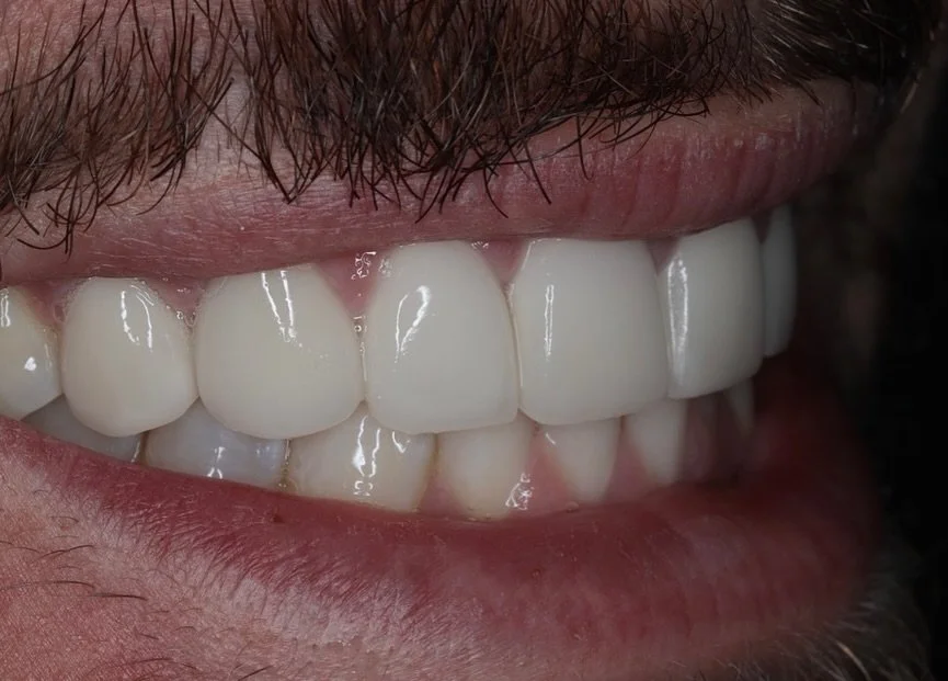 Porcelain Veneers ✨ #porcelainveneers #bostondentist #peabodydentist #fyp