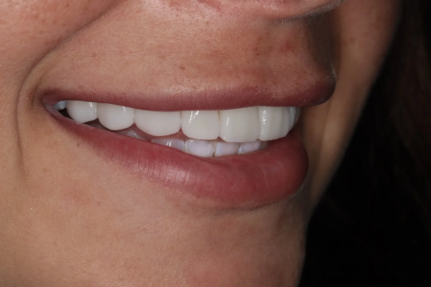 10 Hybrid Veneers 🤍
No dramatic fake smile. No bulky look.
No prep. No drilling. No shaving.

Just a softer, brighter, more balanced version of her smile.

Natural. Refined. Photography-ready.

✨ Completed in just 3 visits

 #NoPrepVeneers #neer #bo