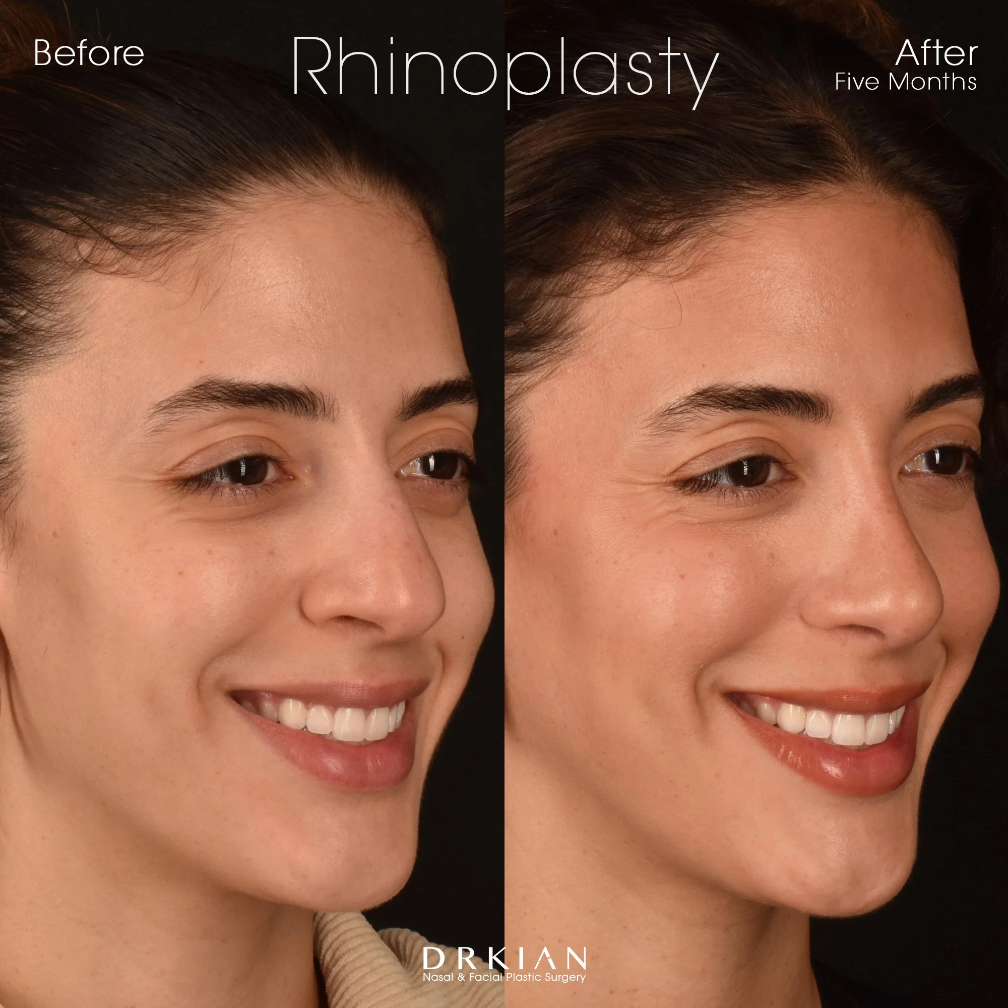 NoseTune® Ultrasonic Rhinoplasty Before & After Four Months
