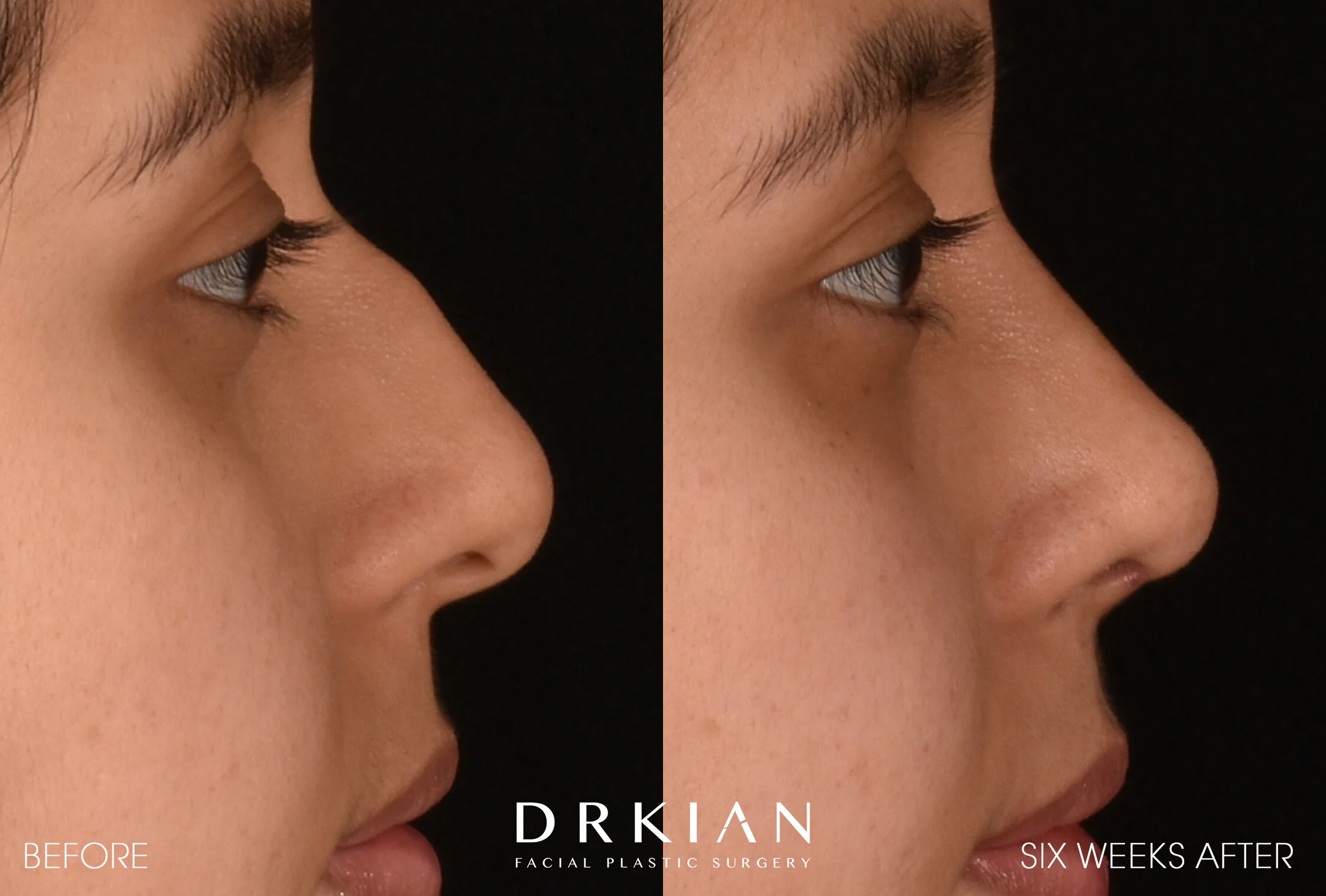 Open Rhinoplasty Before & After 6 Weeks