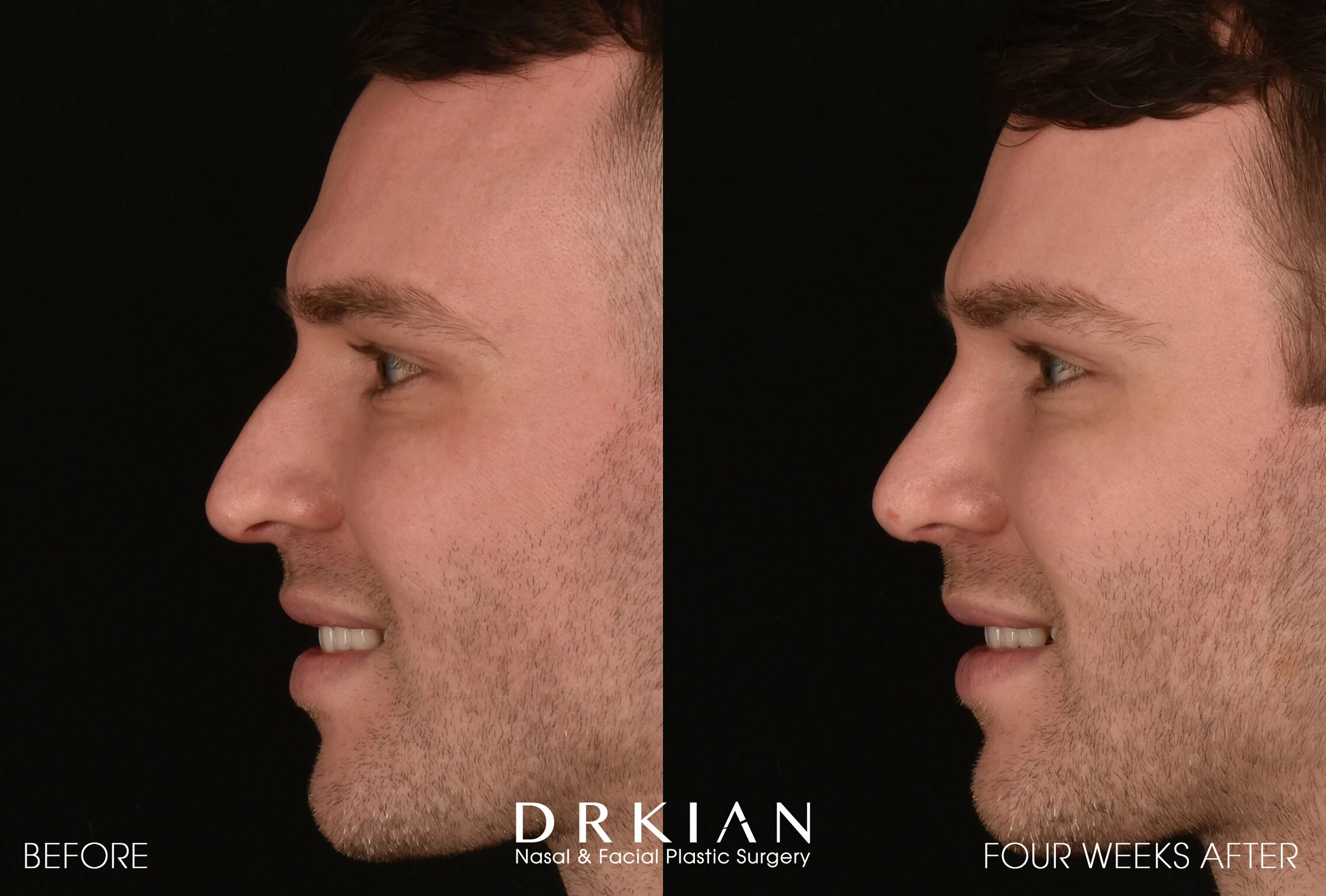 Septorhinoplasty Before & After 4 Weeks