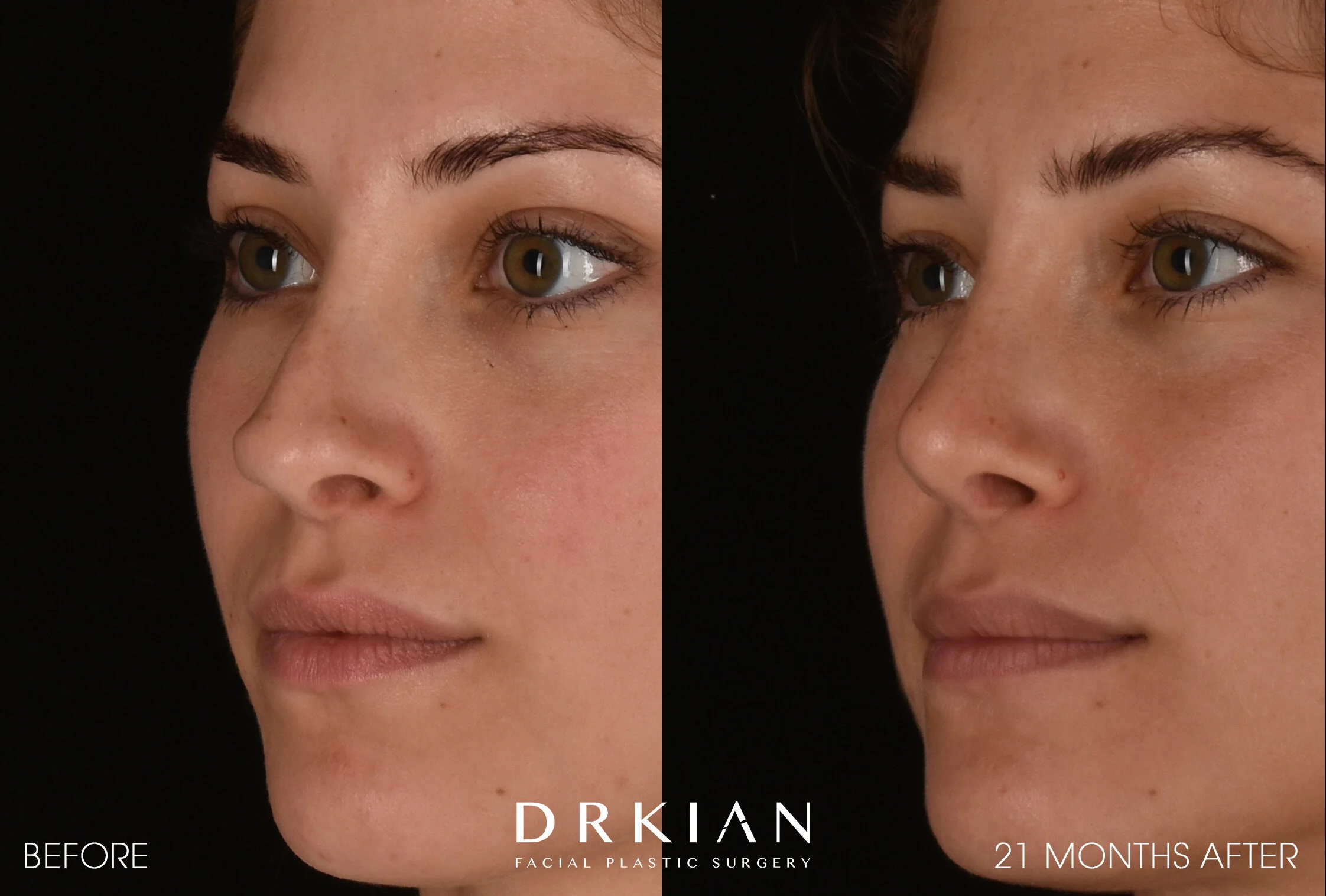 Revision Rhinoplasty Before & After 21 Months