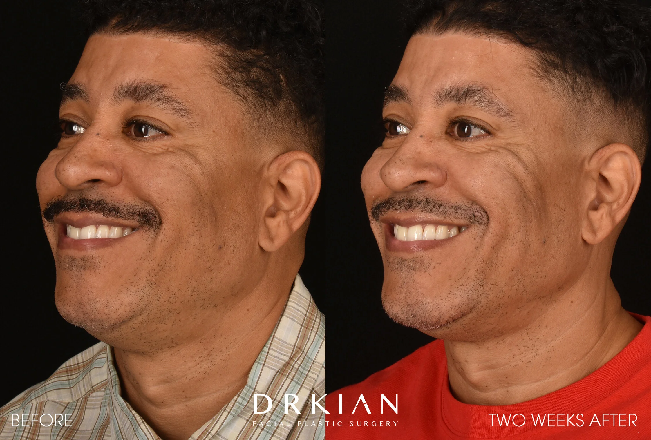 Fat Transfer To Chin Before & After 2 Weeks
