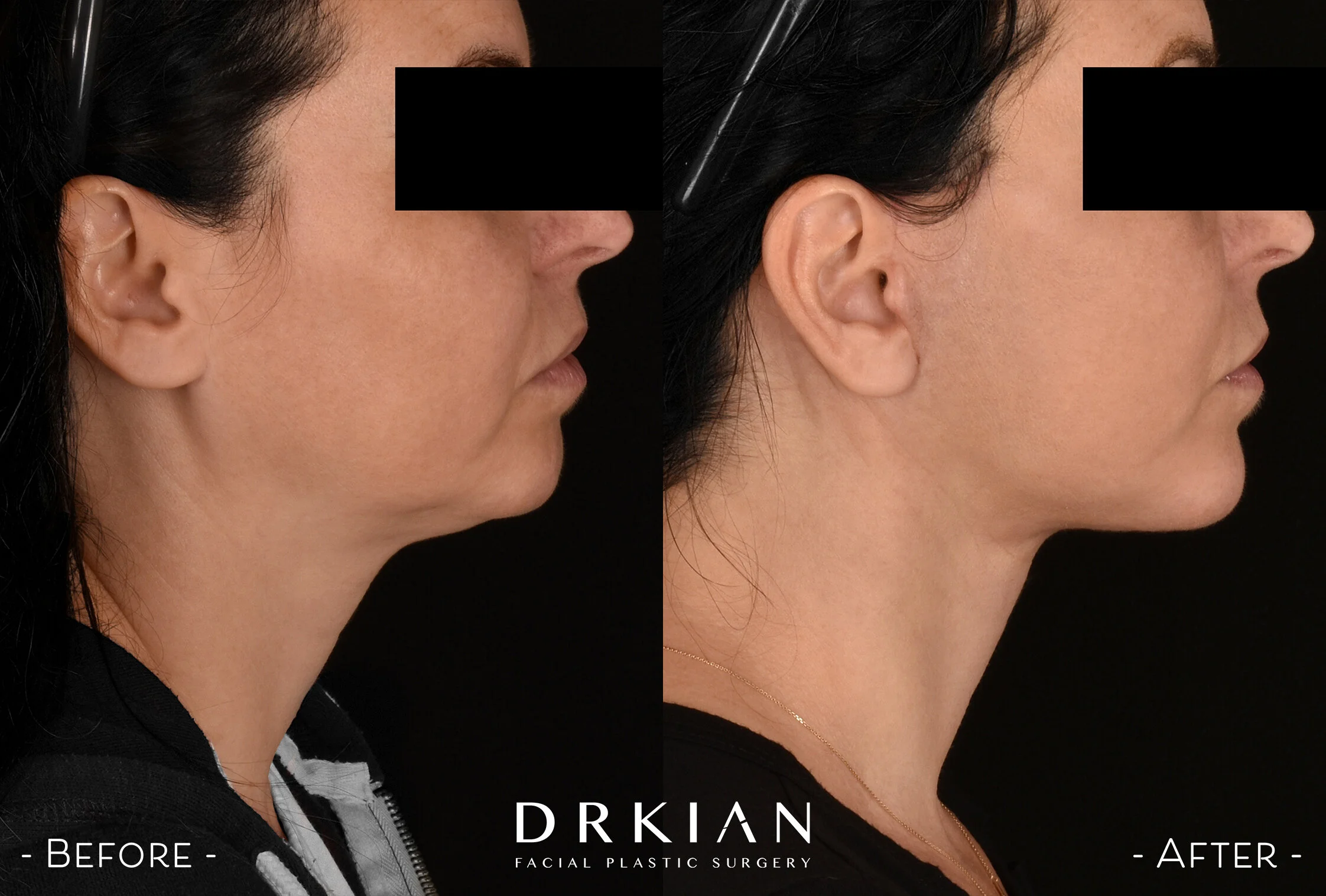 Mid-face Lift, Micro Neck Lift & Fat Transfer to Chin, Marionette Lines, Nasolabial Folds Before & After 3 Weeks