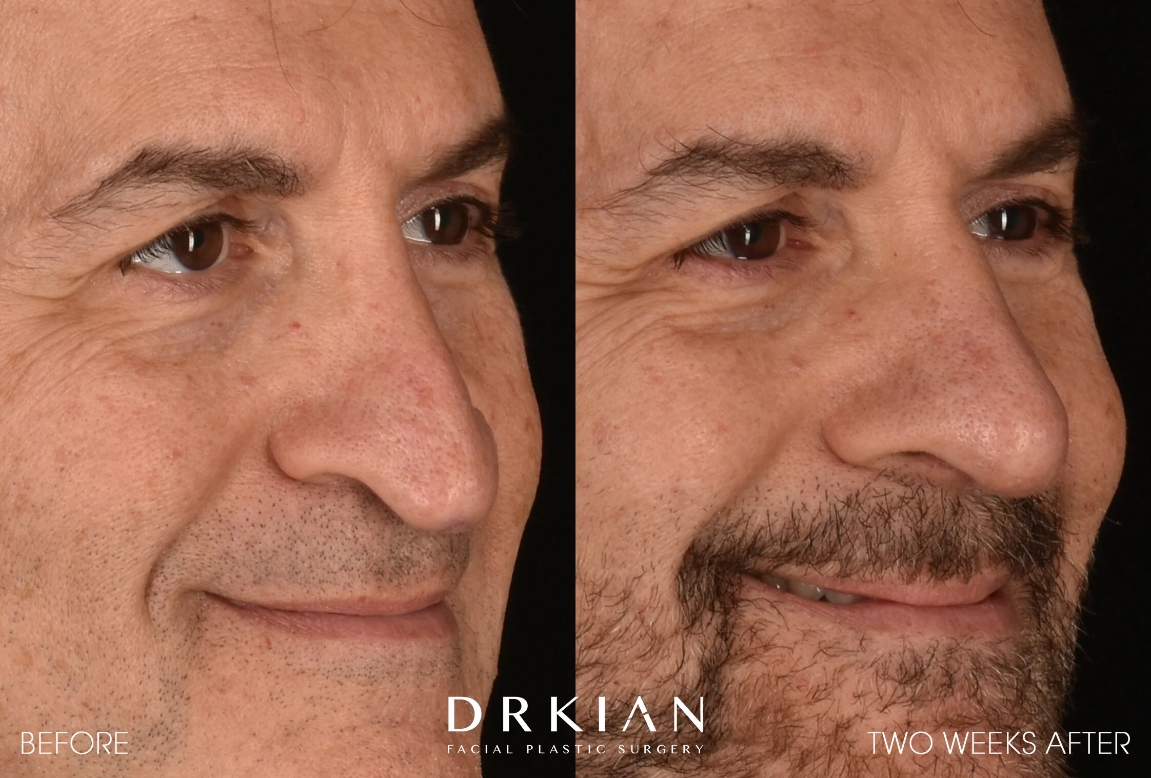 Revision Rhinoplasty Before & After 2 Weeks