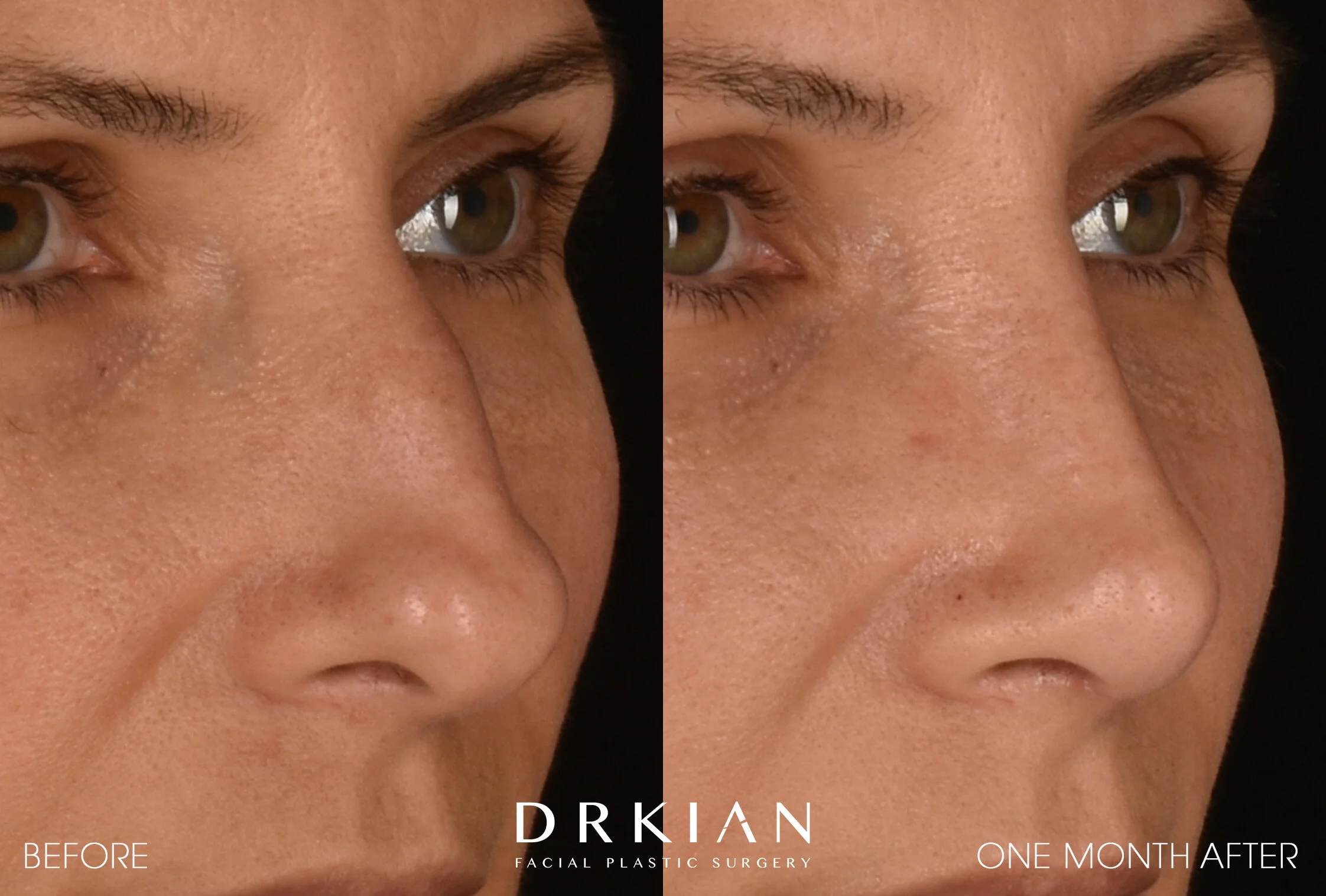 Rhinoplasty Before & After 1 Month