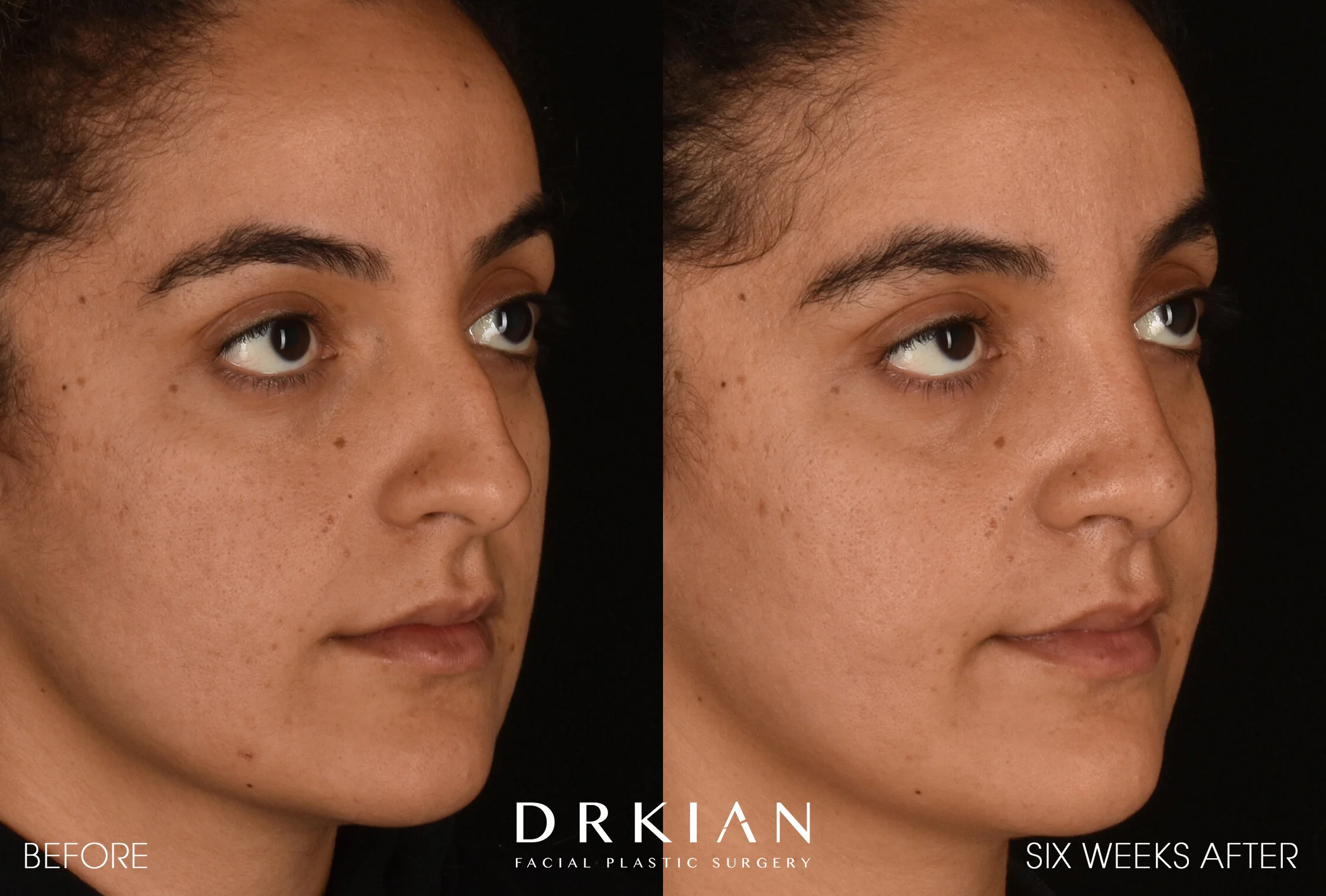 Middle Eastern Rhinoplasty Before & After 6 Weeks