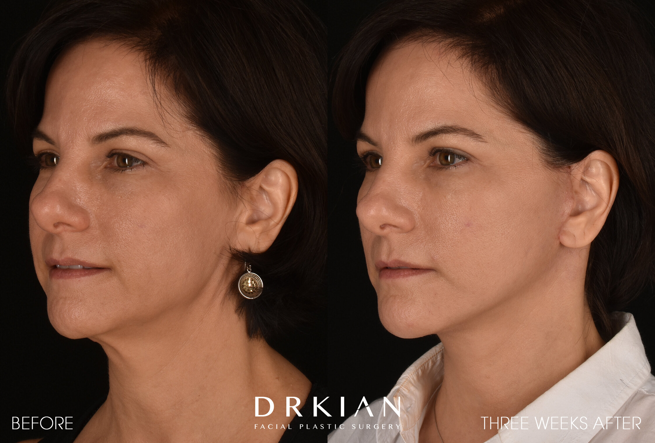 Micro Neck Lift — Dr. Kian