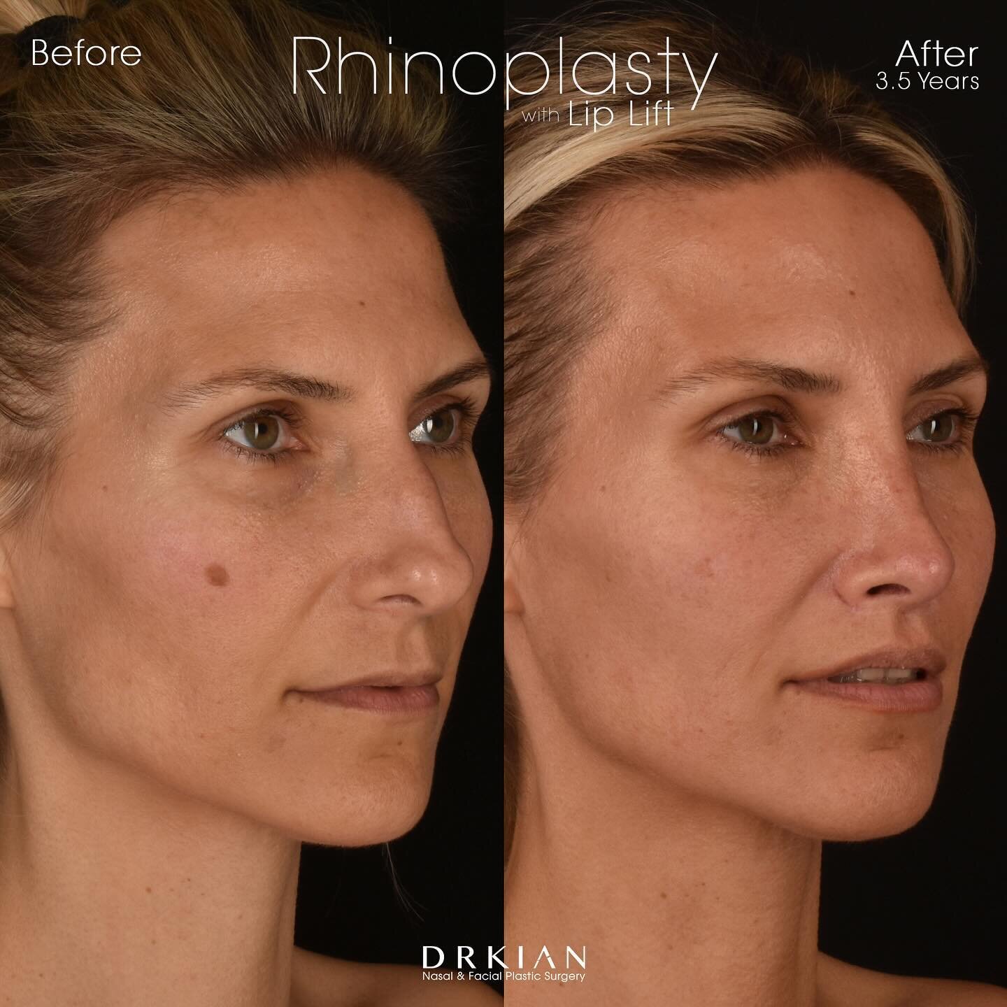 𝐏𝐫𝐨𝐜𝐞𝐝𝐮𝐫𝐞: Rhinoplasty with Bulbous Tip Refinement and Lip Lift
𝐑𝐞𝐬𝐮𝐥𝐭𝐬: Before &amp; Three &amp; a Half Years After
𝐒𝐮𝐫𝐠𝐞𝐨𝐧&rsquo;𝐬 𝐍𝐨𝐭𝐞: After experiencing trauma to her nose twice earlier in her life, Karen decided to p