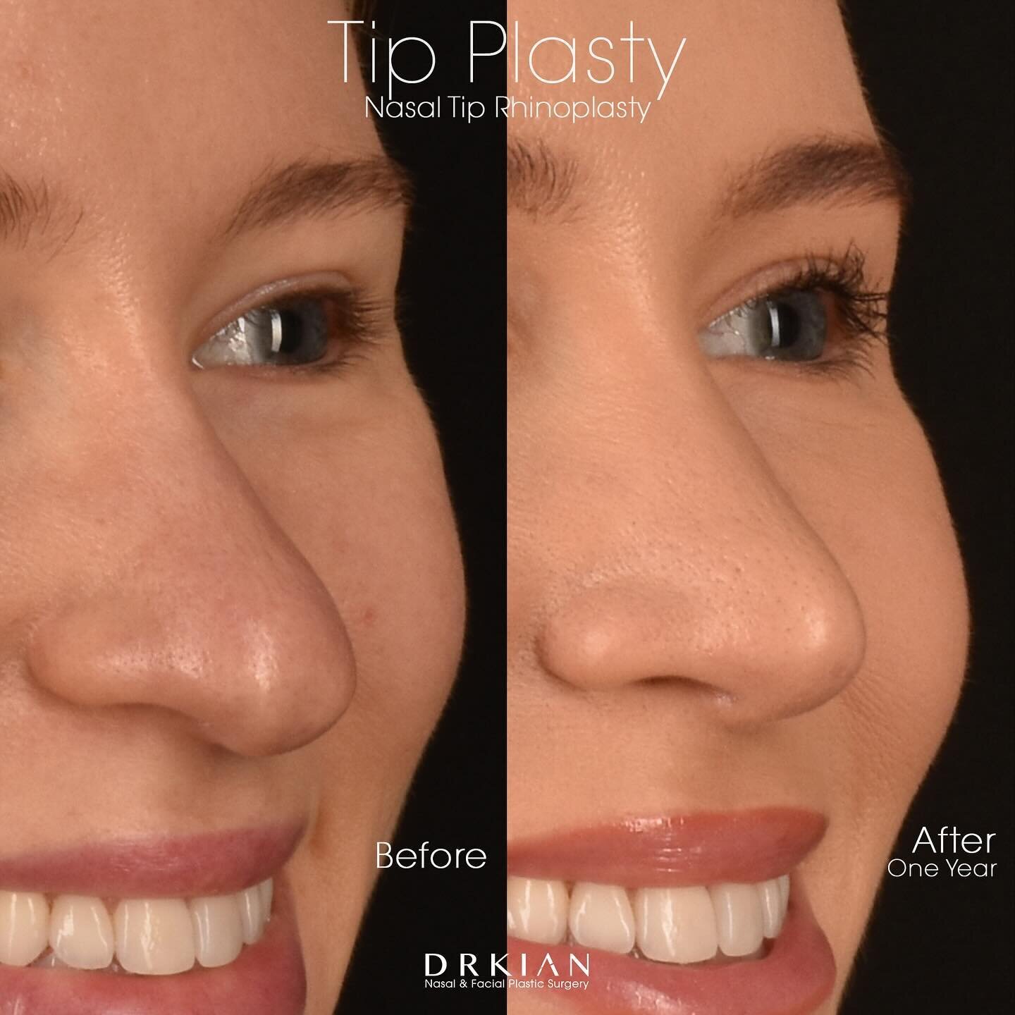 &ldquo;Wow. I saw Dr. Karimi for a rhinoplasty one year ago. And my experience could not have been better. Not only was Dr. Karimi such a warm and kind doctor but his entire staff was phenomenal. I am so happy with my results. He listened to my conce