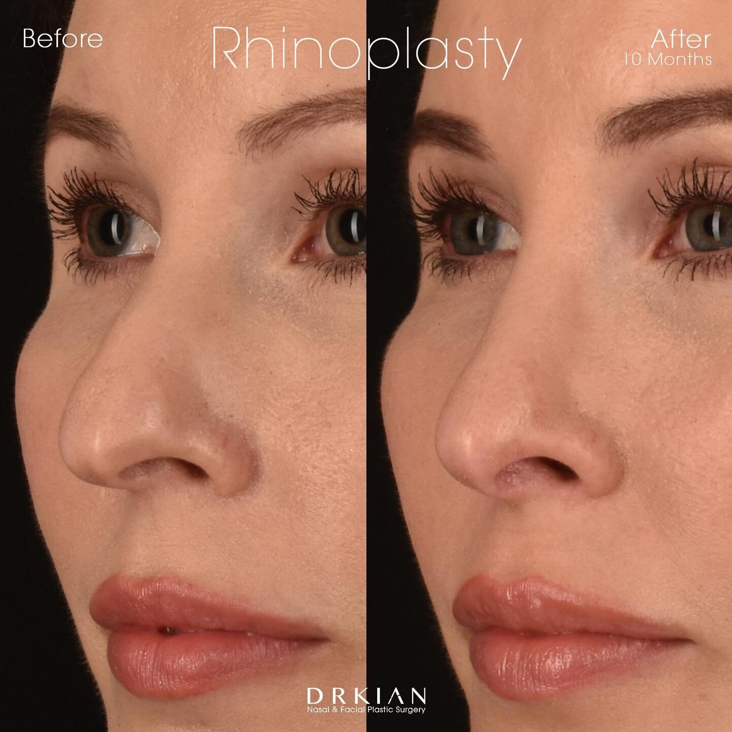 I had the pleasure of seeing my beautiful patient Serene this morning, all the way from San Diego. She is 10 months after undergoing #UltrasonicRhinoplasty for tip refinement, bridge straightening and bump reduction. 

&ldquo;I am so thrilled with my
