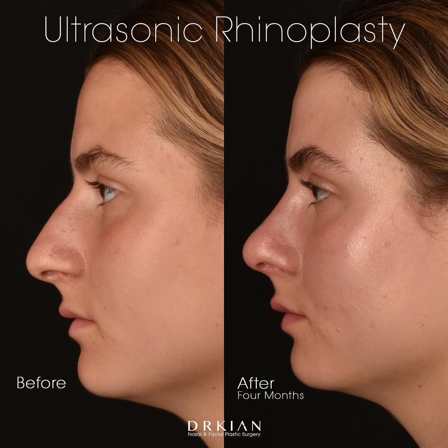 During consultation my younger female patient shared how her side profile, nostril asymmetry and bump contributed to her overall unhappiness with her nose. She desired a more feminine and refined outcome to improve her facial balance and symmetry. Us