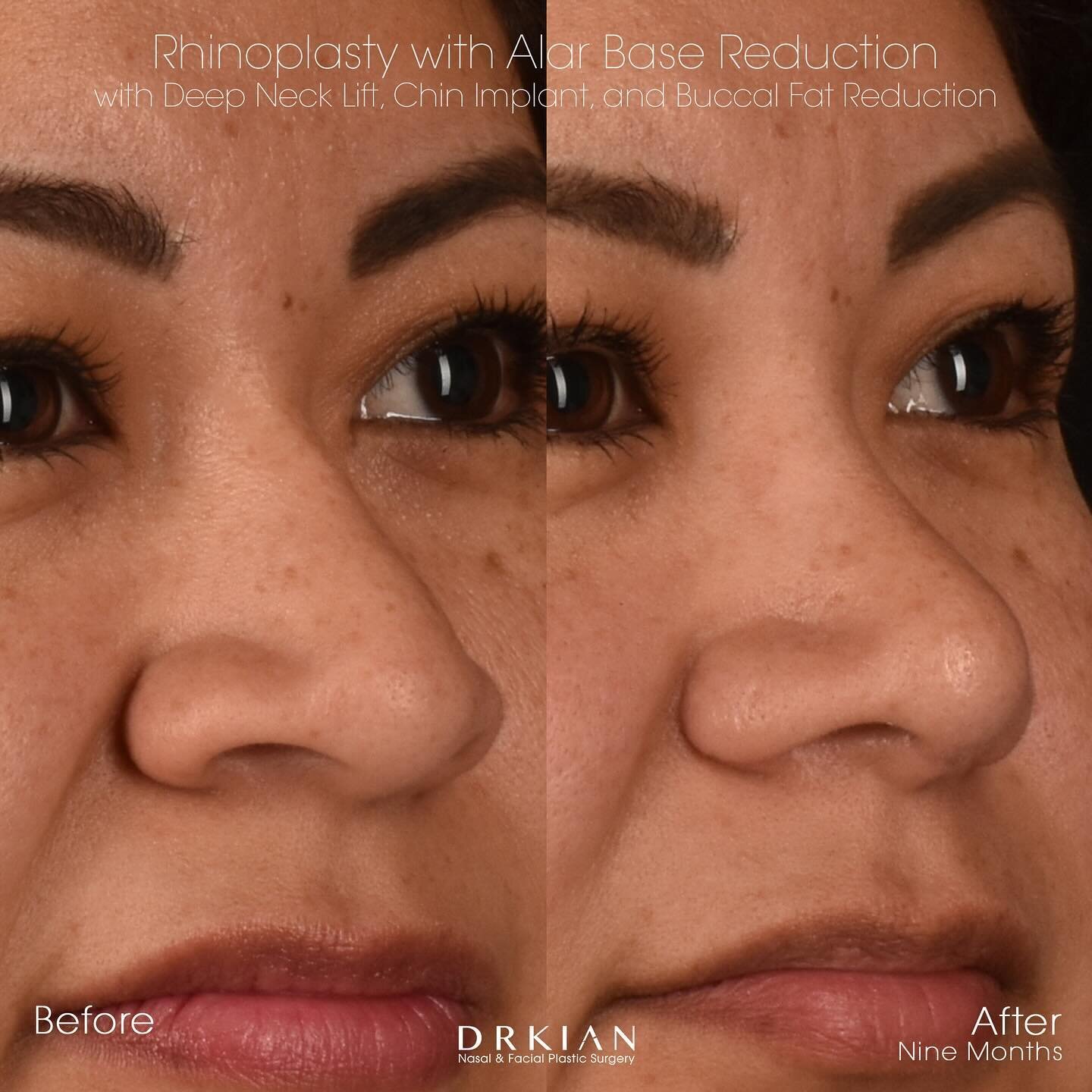 𝐏𝐫𝐨𝐜𝐞𝐝𝐮𝐫𝐞: Rhinoplasty with Alar Base Reduction, Bilateral Turbinoplasty, Chin Implant, Deep Neck Lift and Buccal Fat Reduction
𝐑𝐞𝐬𝐮𝐥𝐭𝐬: Before &amp; After Nine Months
𝐒𝐮𝐫𝐠𝐞𝐨𝐧&rsquo;𝐬 𝐍𝐨𝐭𝐞: Vicki is nine months out from he