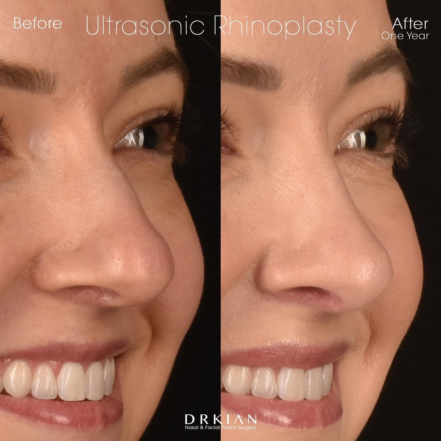 I love celebrating one year anniversaries with my patients! My gorgeous young patient returned to the clinic today for her follow-up appointment, one full year after undergoing #UltrasonicRhinoplasty with me. What do you think of these beautiful tip 