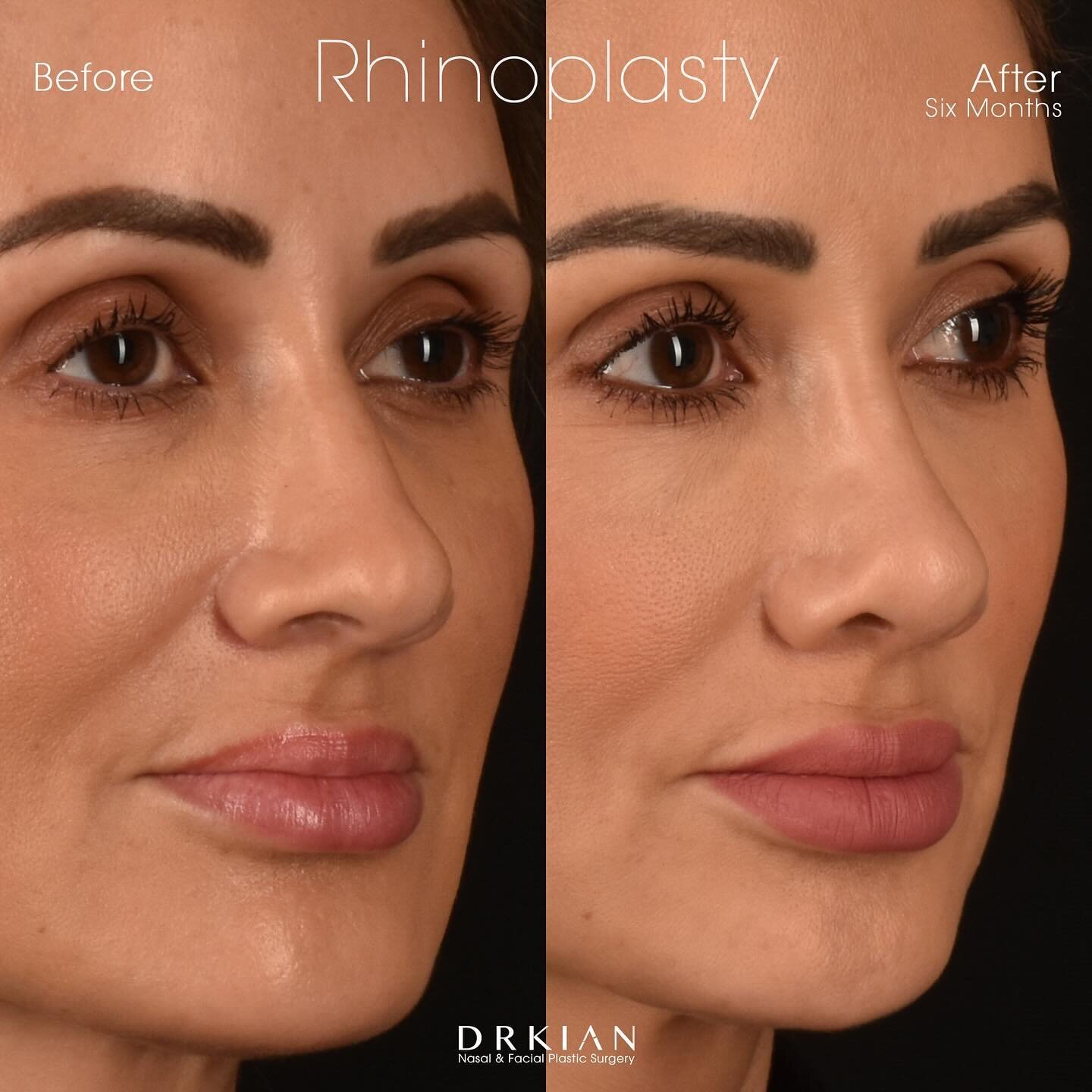 As an aesthetic practitioner, Melissa was well aware of the transformative impact such a procedure could have on an individual&rsquo;s confidence and overall quality of life. She decided to undergo cosmetic rhinoplasty procedure to address these issu
