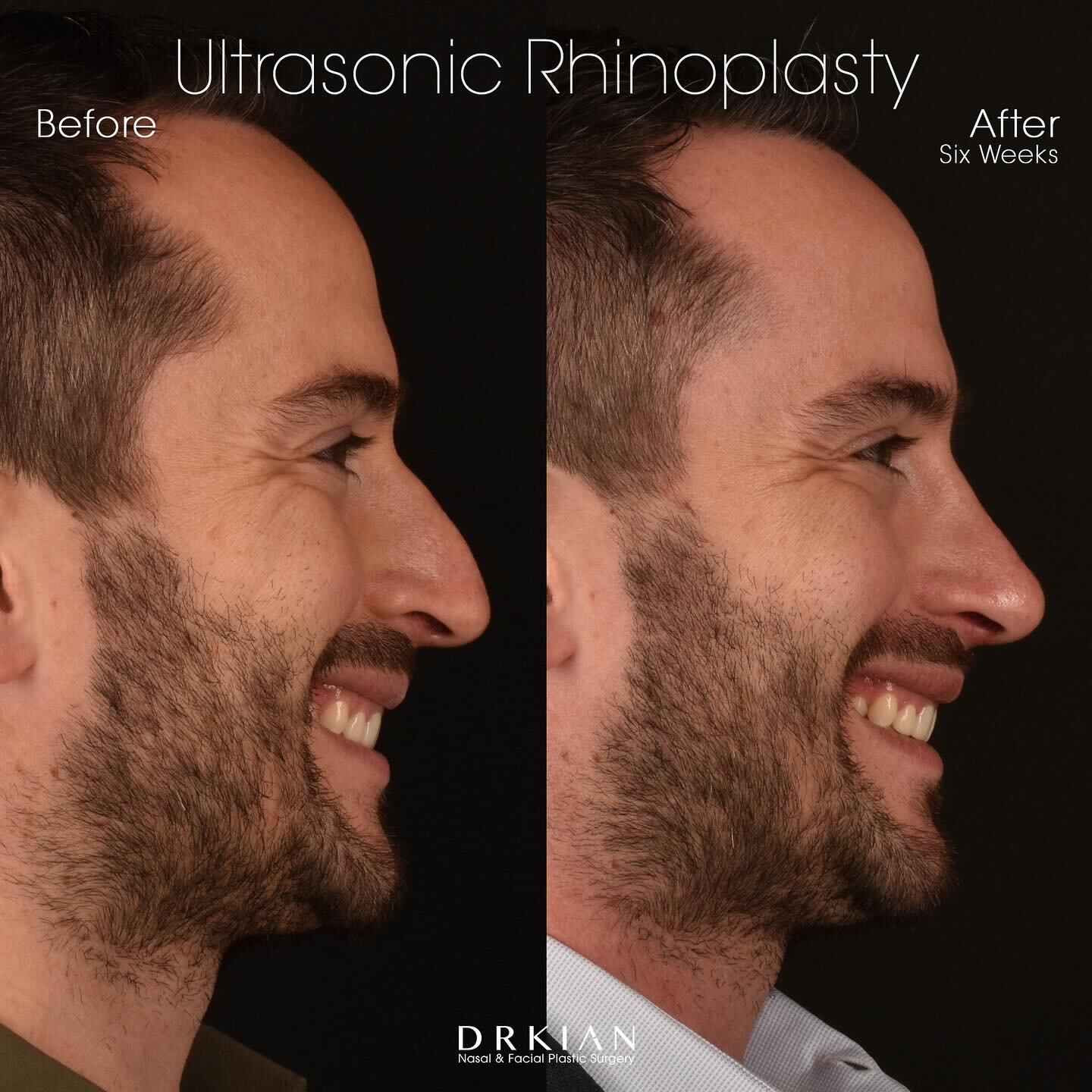 During consultation my handsome patient shared that his primary concern was how his tip dips downward when smiling which he wanted to improve without altering his appearance. He had thought about undergoing cosmetic rhinoplasty procedure for years, d
