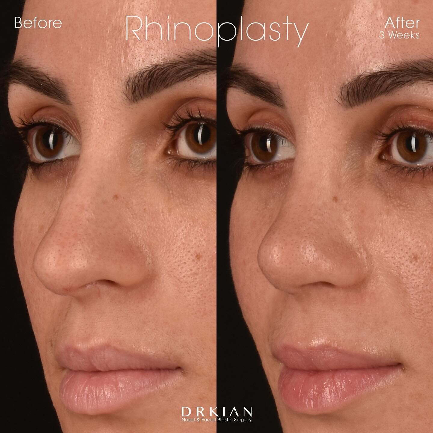 𝐏𝐫𝐨𝐜𝐞𝐝𝐮𝐫𝐞: Open Cosmetic Rhinoplasty
𝐑𝐞𝐬𝐮𝐥𝐭𝐬: Before &amp; After Three Weeks
𝐒𝐮𝐫𝐠𝐞𝐨𝐧&rsquo;𝐬 𝐍𝐨𝐭𝐞: This is an early preview of the final outcome. As swelling subsides over time, true results will become visible.

Choosing 