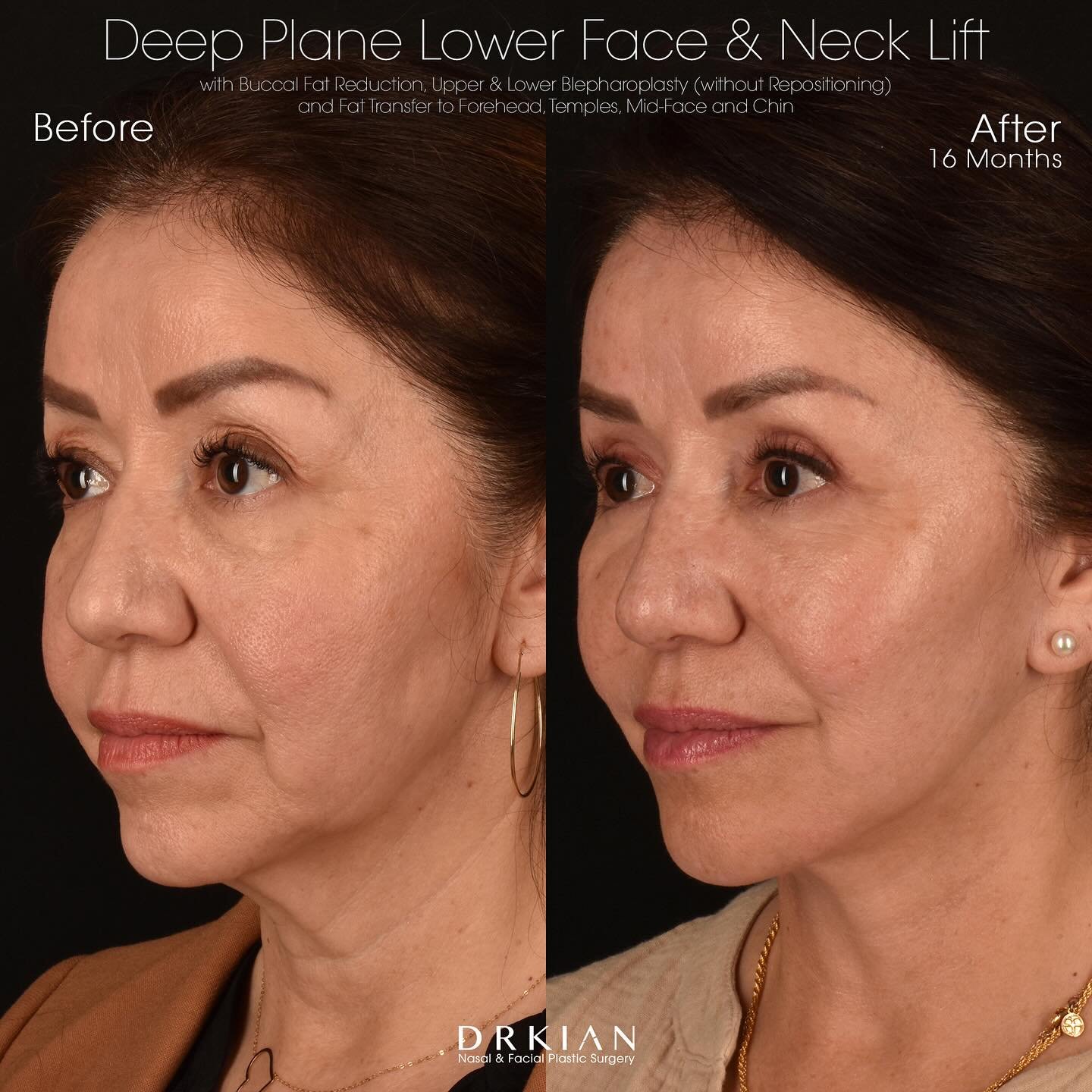 Often, the most beautiful transformations are achieved through combining a series of small (or maybe even &lsquo;subtle&rsquo;) improvements that together will produce a stunning (and more natural-looking) outcome. Patients who are interested in unde