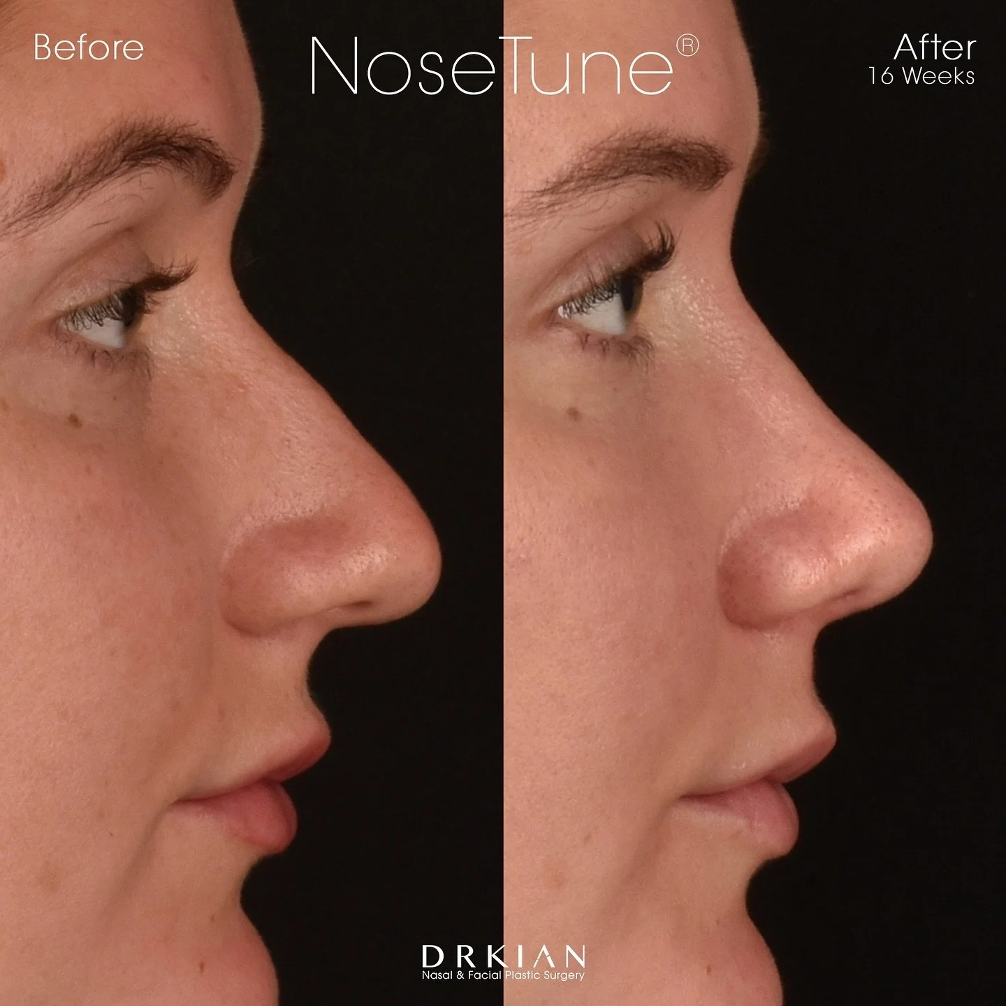 What is a NoseTune&reg; Rhinoplasty? This is something that I&rsquo;ve been developing for many, many years and essentially it is creating the best version of your nose. NoseTune&reg; is my approach to achieving a natural, often subtle enhancement to