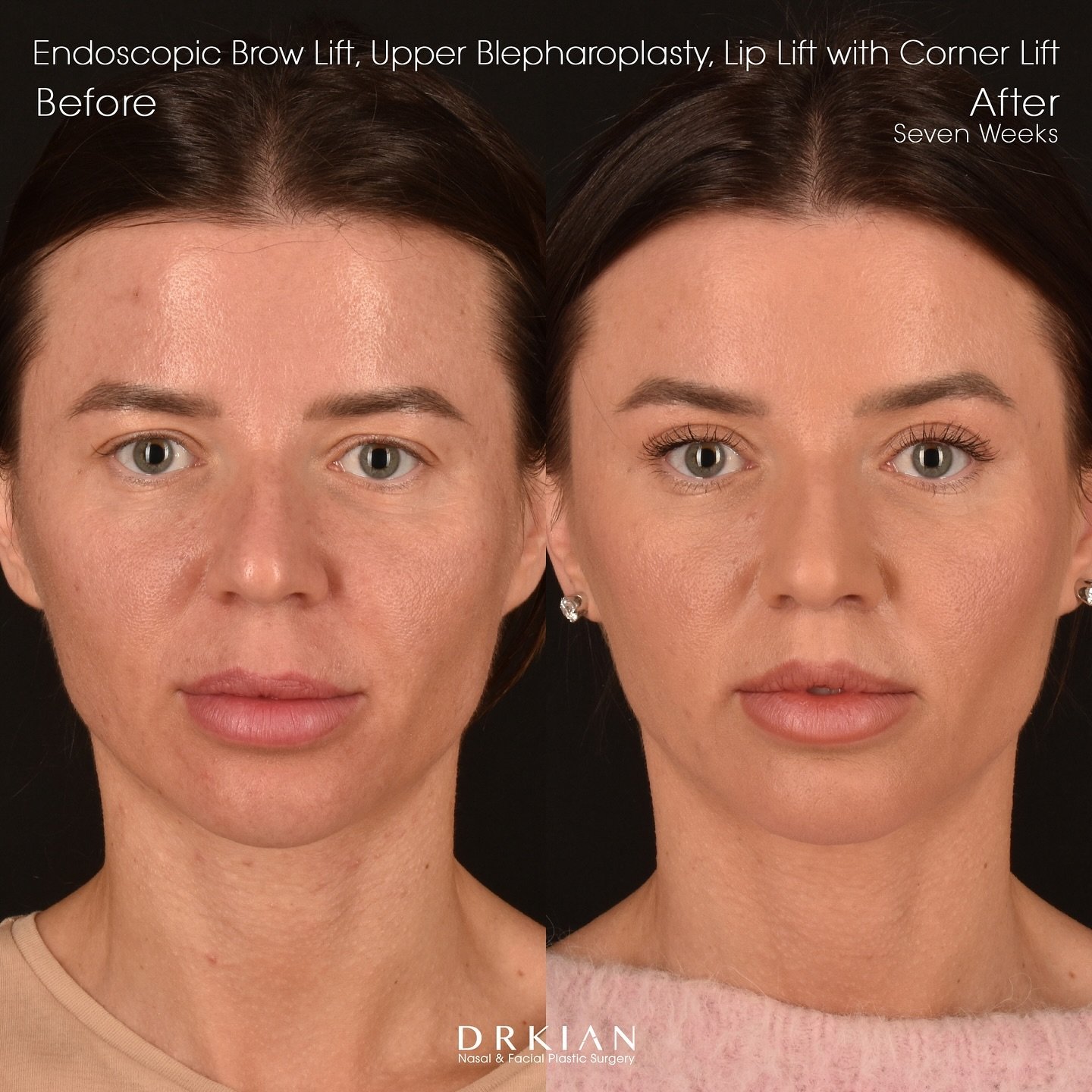 Seven weeks after undergoing an Endoscopic Brow Lift, Upper Eyelid Blepharoplasty, and Upper Lip Lift with Corner Lift, Slava returned to the clinic to share her stunning results with us. She is over the moon, as am I! Her outcome is stunning and we 