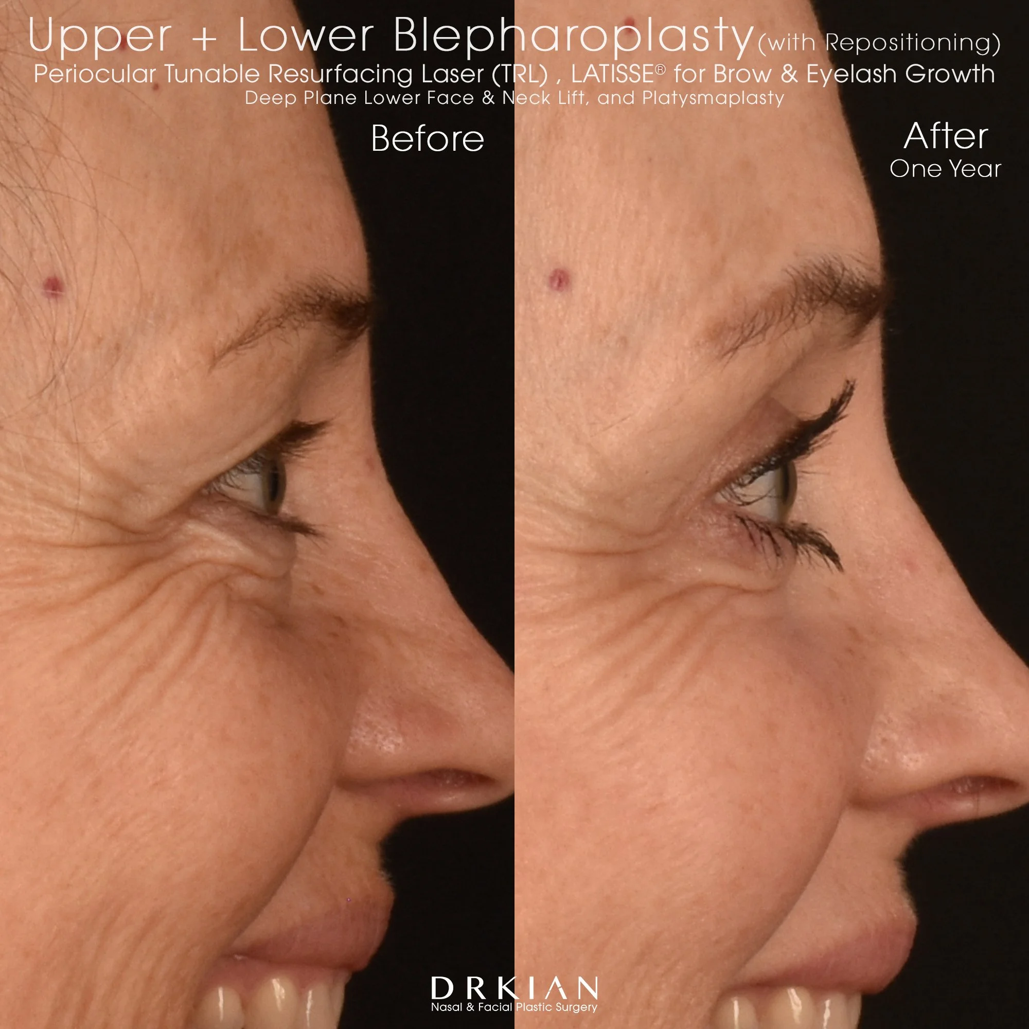 Deep Plane Lower Face & Neck Lift with Platysmaplasty, Upper Blepharoplasty + Lower Blepharoplasty with Repositioning, Periocular Tunable Resurfacing Laser (TRL) and LATISSE® for Brow & Eyelash Growth: Before & After One Year