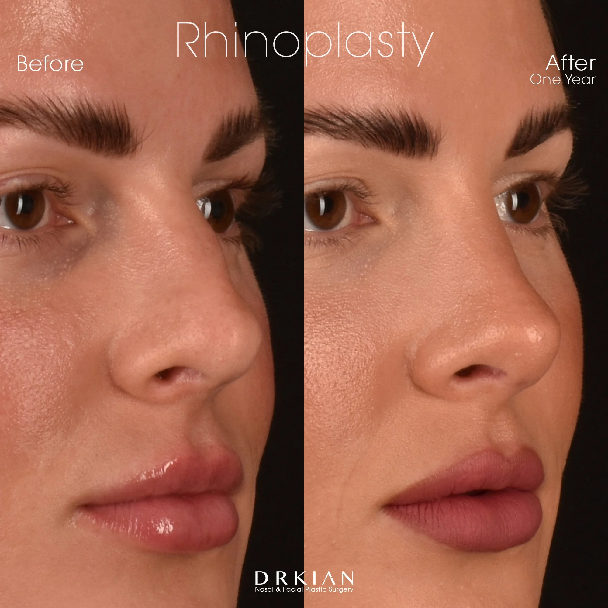 NoseTune® Rhinoplasty, Septoplasty with SONOPET Ultrasonic Aspirator Before & After One Year
