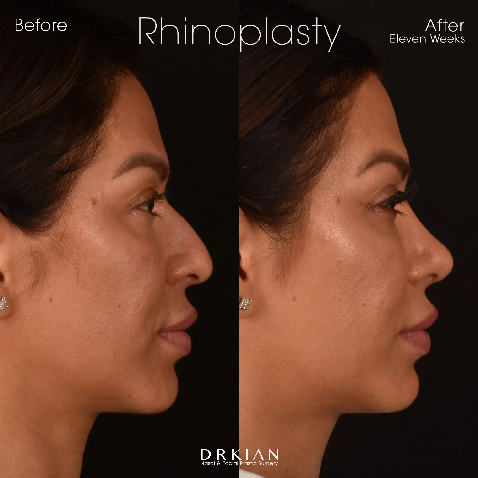 Open Cosmetic Rhinoplasty: Before & After Eleven Weeks