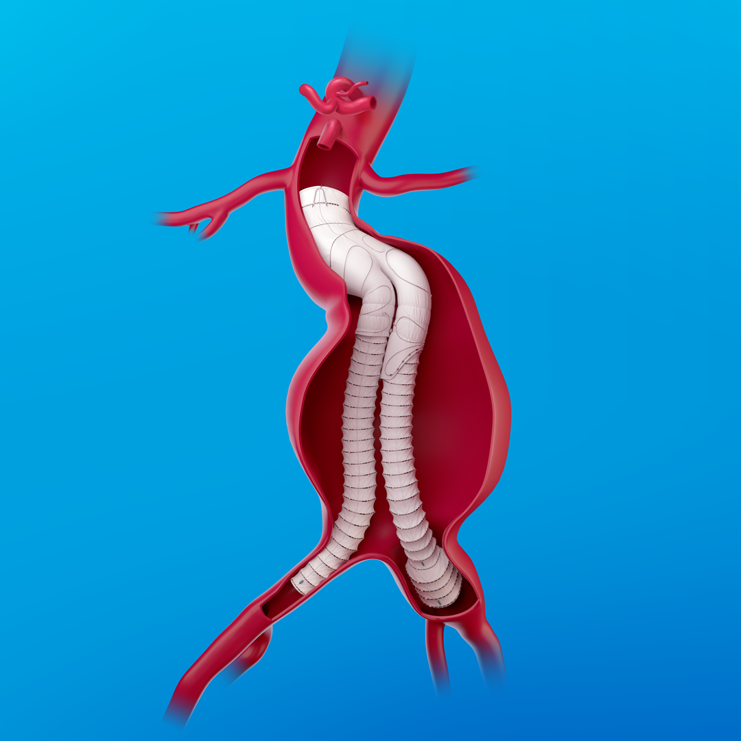 3D Aortic Graft: Medical Device Promotional Illustrations