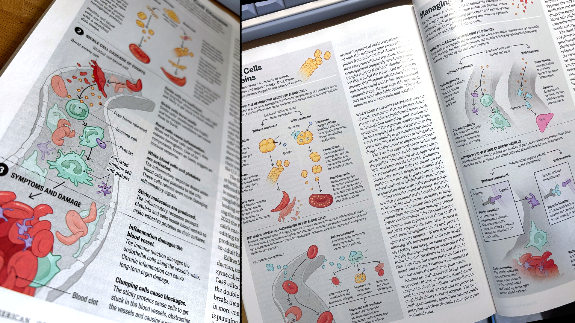 Scientific american Sickle Cell Anemia magazine infographic. Medical illustration for publication