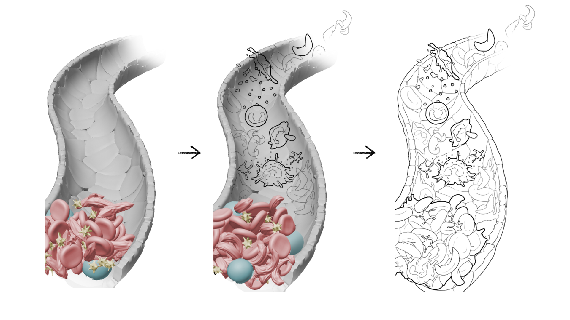 Work in progress of sickle cell anemia medical illustration for Scientific american magazine publication